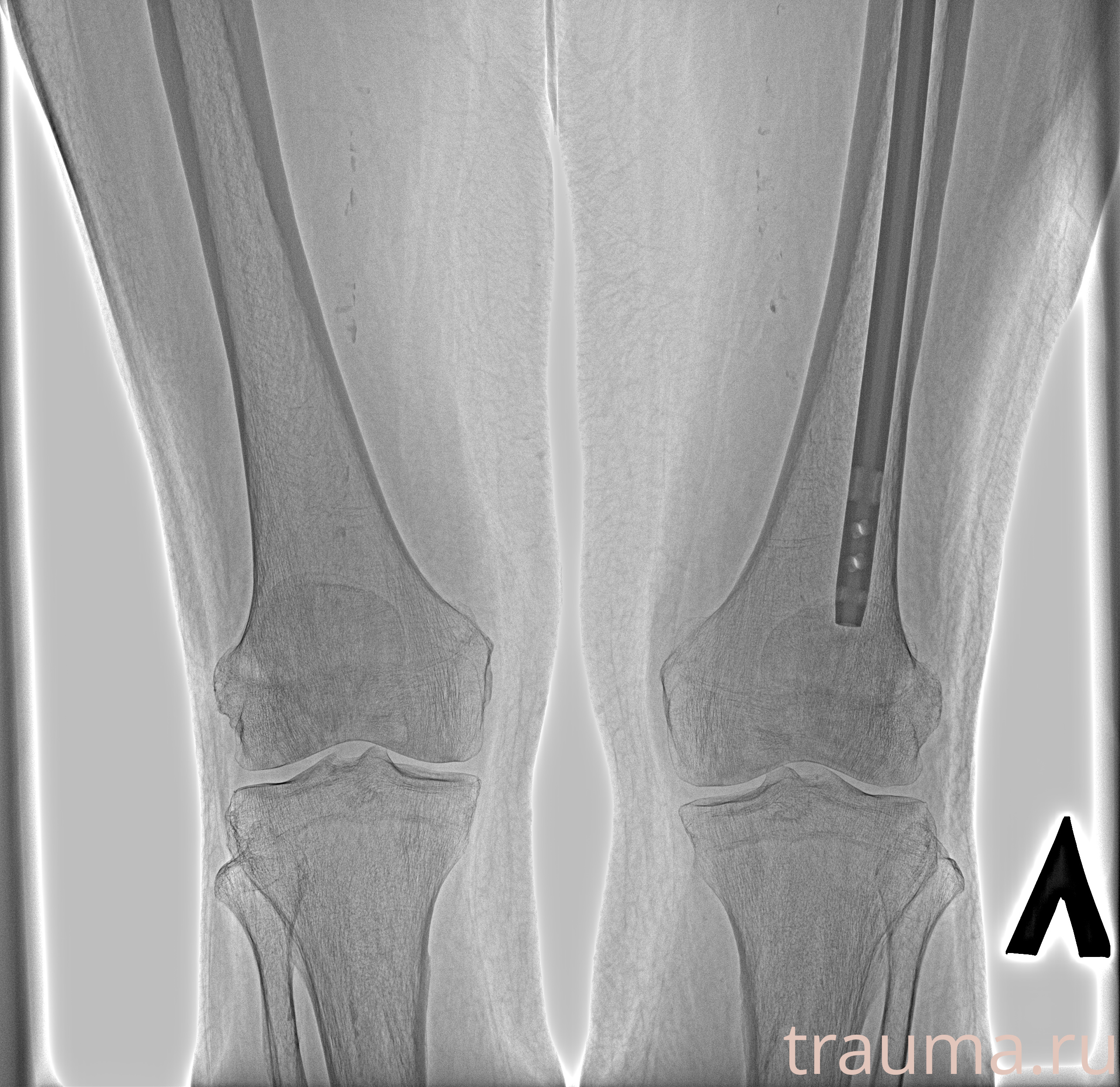 Рентген на дому: по вашему адресу приезжает врач-рентгенолог, травматолог-ортопед с мобильным рентгеновским аппаратом, проводит диагностику травмы или заболевания, делает необходимые рентгенограммы, дает рекомендации по дальнейшему лечению. Получить качественные снимки в домашних условиях возможно благодаря уникальной методике, разработанной МосРентген Центром для института  Склифосовского
