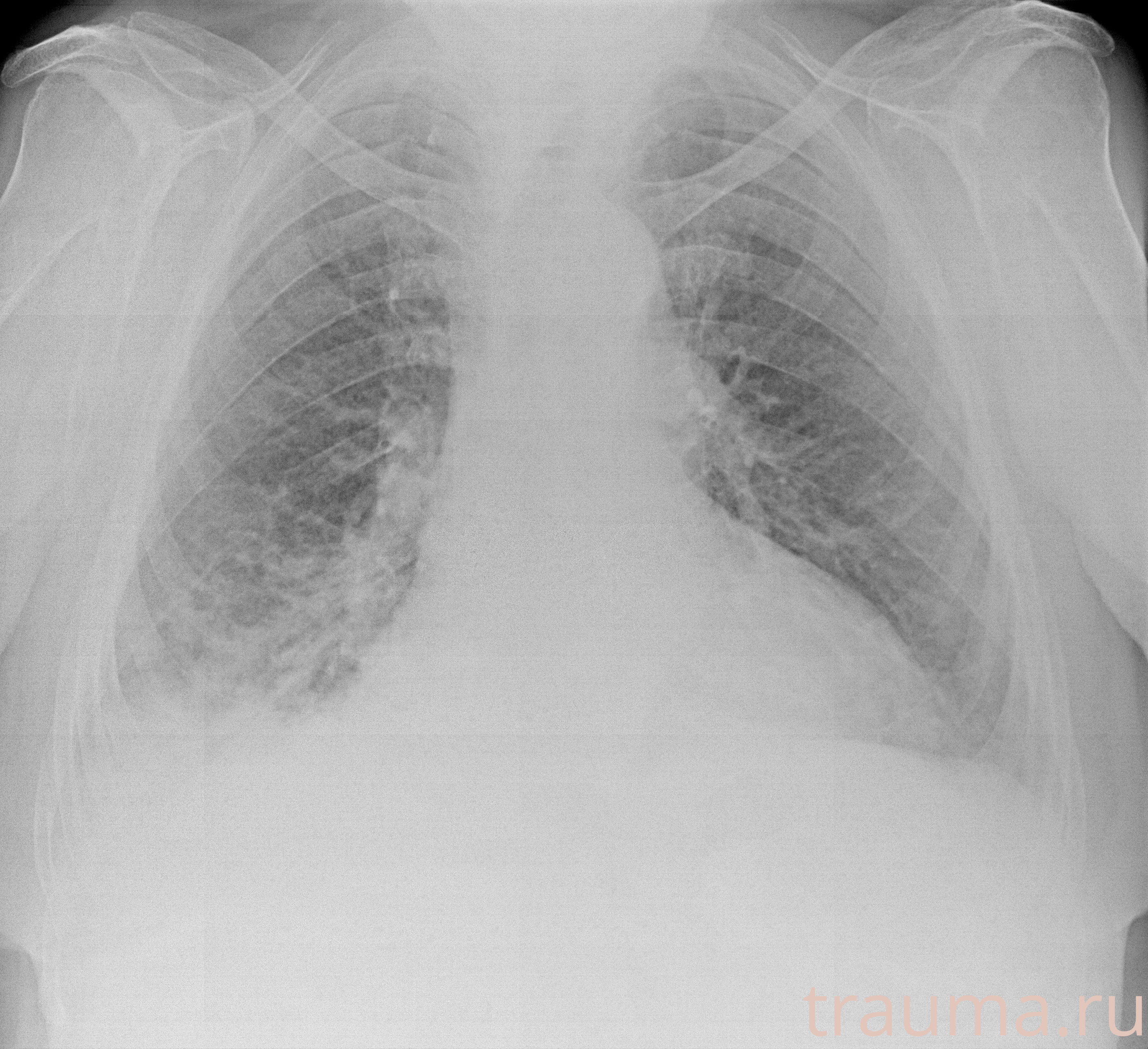 Рентген на дому: по вашему адресу приезжает врач-рентгенолог, травматолог-ортопед с мобильным рентгеновским аппаратом, проводит диагностику травмы или заболевания, делает необходимые рентгенограммы, дает рекомендации по дальнейшему лечению. Получить качественные снимки в домашних условиях возможно благодаря уникальной методике, разработанной МосРентген Центром для института  Склифосовского