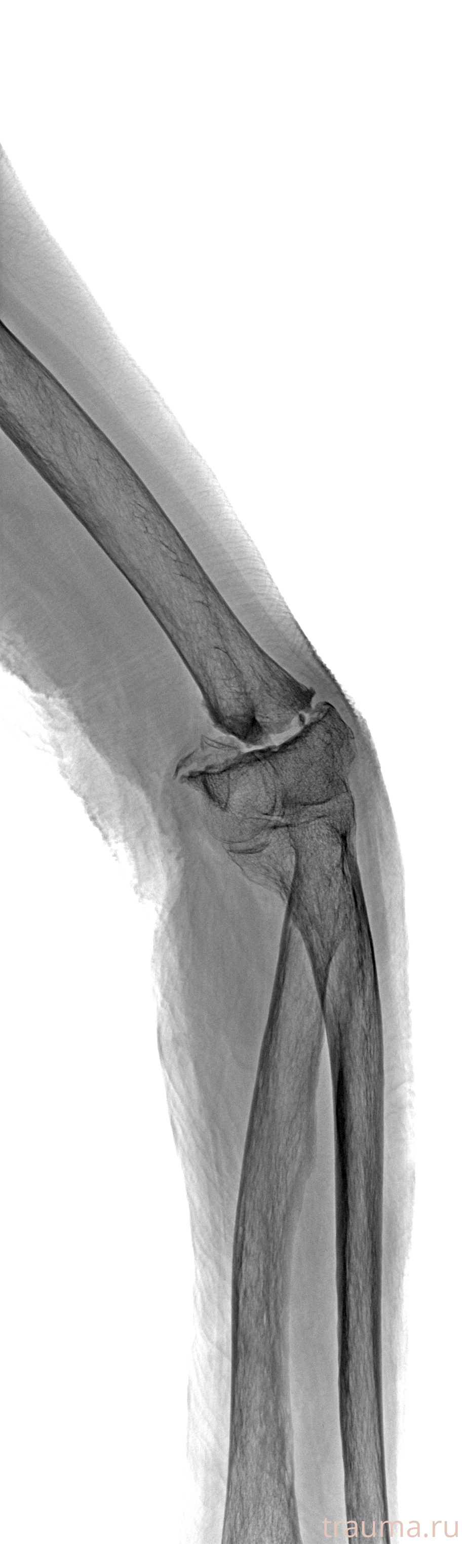 Рентген на дому: по вашему адресу приезжает врач-рентгенолог, травматолог-ортопед с мобильным рентгеновским аппаратом, проводит диагностику травмы или заболевания, делает необходимые рентгенограммы, дает рекомендации по дальнейшему лечению. Получить качественные снимки в домашних условиях возможно благодаря уникальной методике, разработанной МосРентген Центром для института  Склифосовского