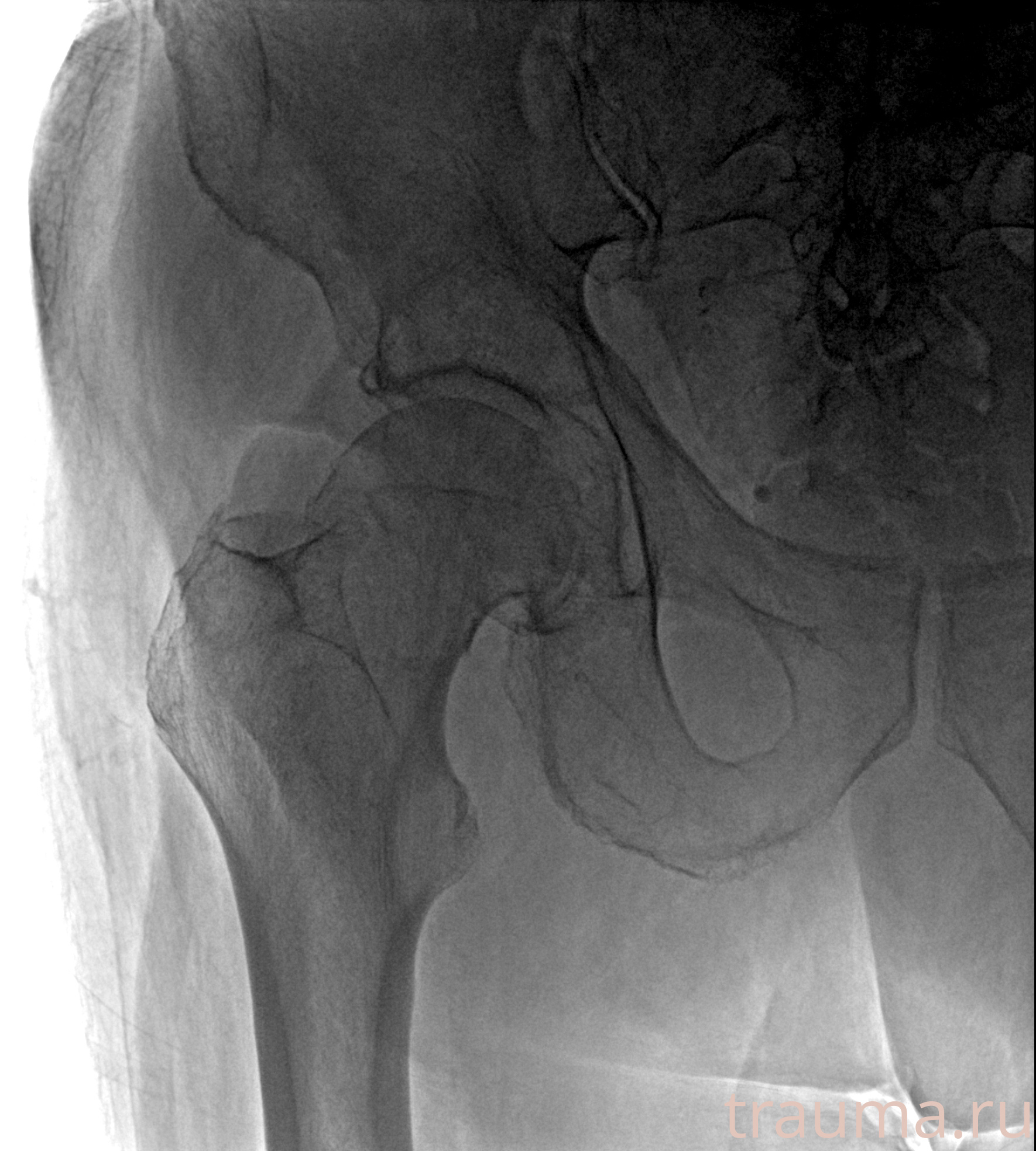 Рентген на дому: по вашему адресу приезжает врач-рентгенолог, травматолог-ортопед с мобильным рентгеновским аппаратом, проводит диагностику травмы или заболевания, делает необходимые рентгенограммы, дает рекомендации по дальнейшему лечению. Получить качественные снимки в домашних условиях возможно благодаря уникальной методике, разработанной МосРентген Центром для института  Склифосовского