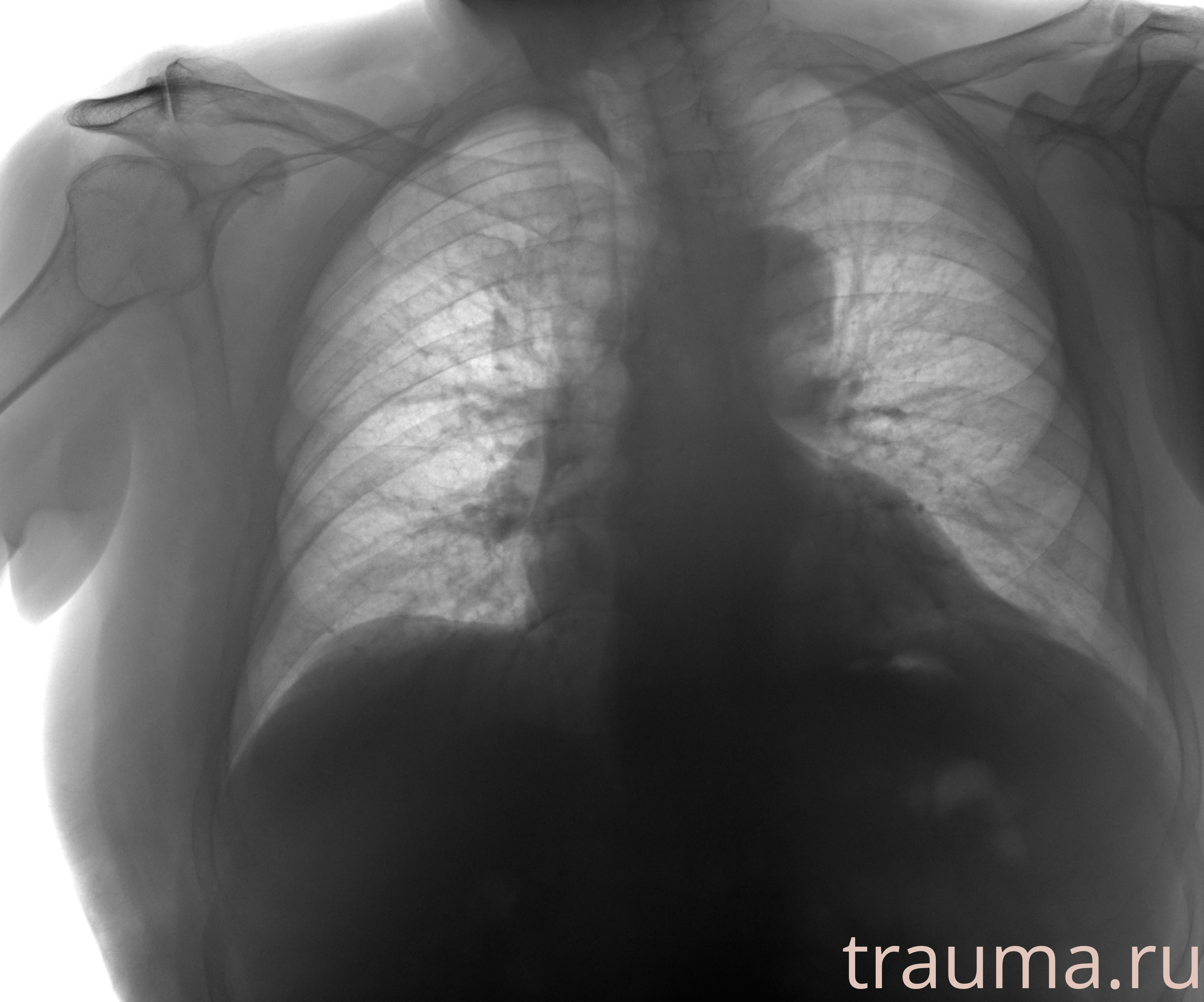 Рентген на дому: по вашему адресу приезжает врач-рентгенолог, травматолог-ортопед с мобильным рентгеновским аппаратом, проводит диагностику травмы или заболевания, делает необходимые рентгенограммы, дает рекомендации по дальнейшему лечению. Получить качественные снимки в домашних условиях возможно благодаря уникальной методике, разработанной МосРентген Центром для института  Склифосовского