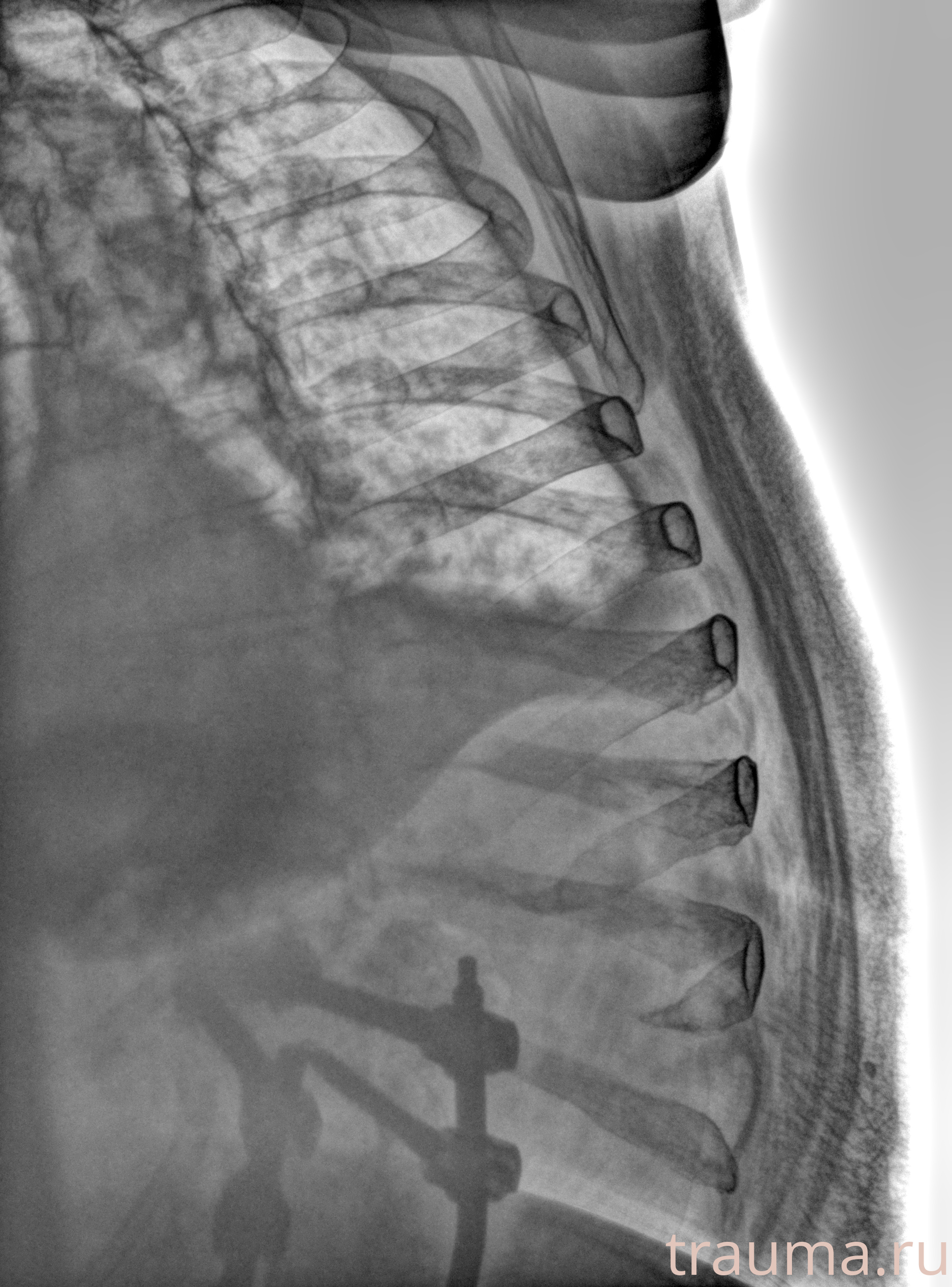 Рентген на дому: по вашему адресу приезжает врач-рентгенолог, травматолог-ортопед с мобильным рентгеновским аппаратом, проводит диагностику травмы или заболевания, делает необходимые рентгенограммы, дает рекомендации по дальнейшему лечению. Получить качественные снимки в домашних условиях возможно благодаря уникальной методике, разработанной МосРентген Центром для института  Склифосовского