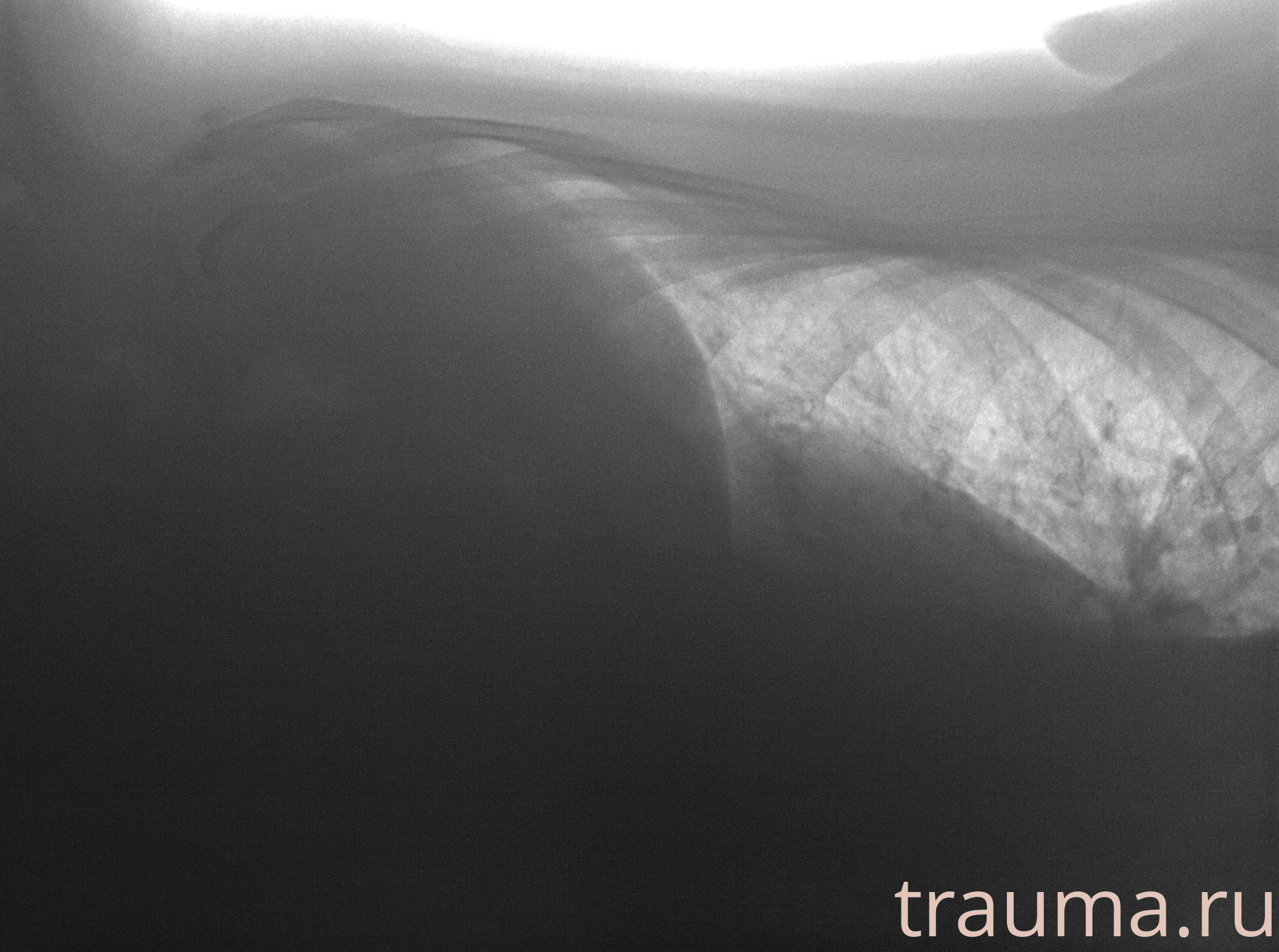 Рентген на дому: по вашему адресу приезжает врач-рентгенолог, травматолог-ортопед с мобильным рентгеновским аппаратом, проводит диагностику травмы или заболевания, делает необходимые рентгенограммы, дает рекомендации по дальнейшему лечению. Получить качественные снимки в домашних условиях возможно благодаря уникальной методике, разработанной МосРентген Центром для института  Склифосовского