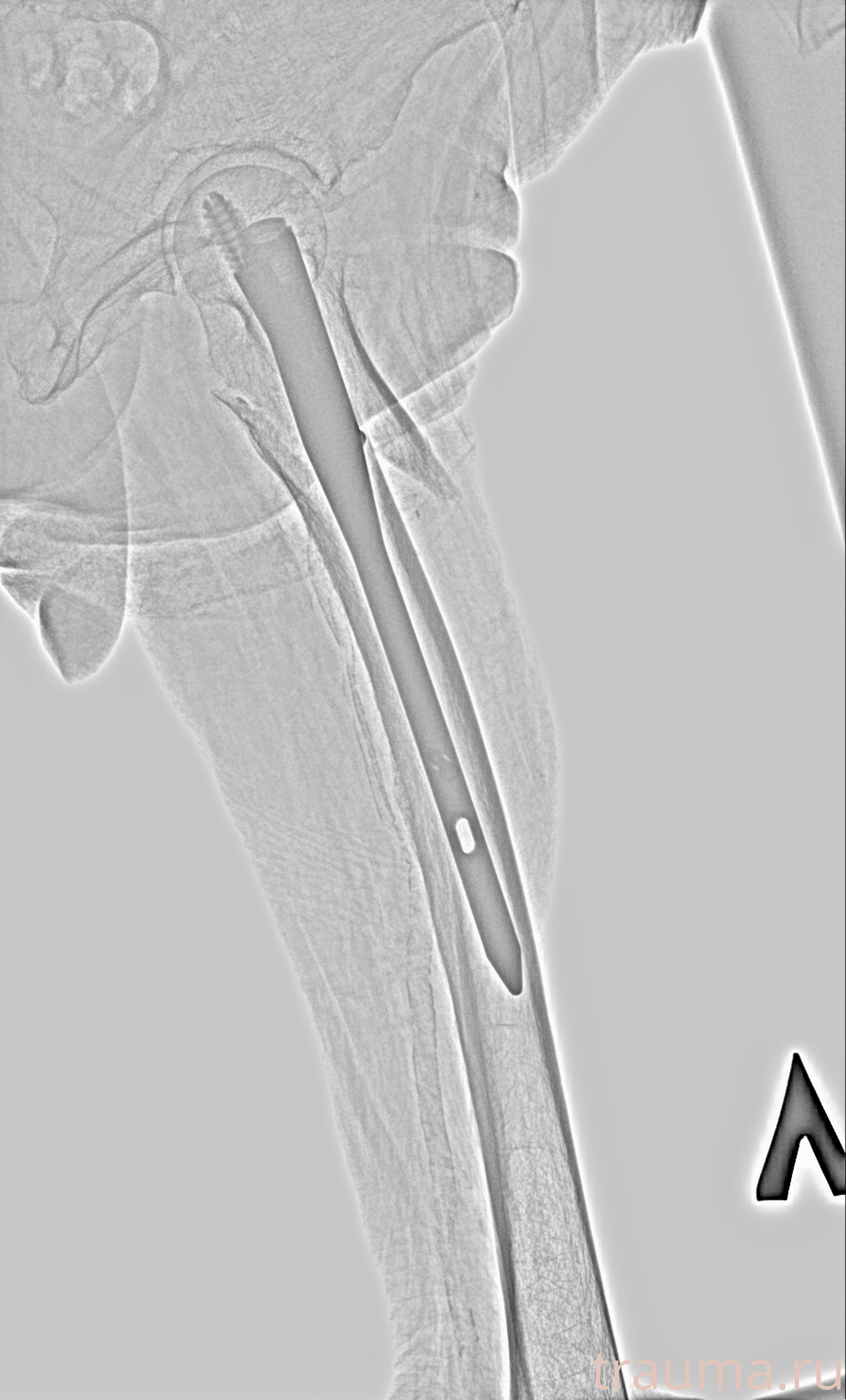Рентген на дому: по вашему адресу приезжает врач-рентгенолог, травматолог-ортопед с мобильным рентгеновским аппаратом, проводит диагностику травмы или заболевания, делает необходимые рентгенограммы, дает рекомендации по дальнейшему лечению. Получить качественные снимки в домашних условиях возможно благодаря уникальной методике, разработанной МосРентген Центром для института  Склифосовского