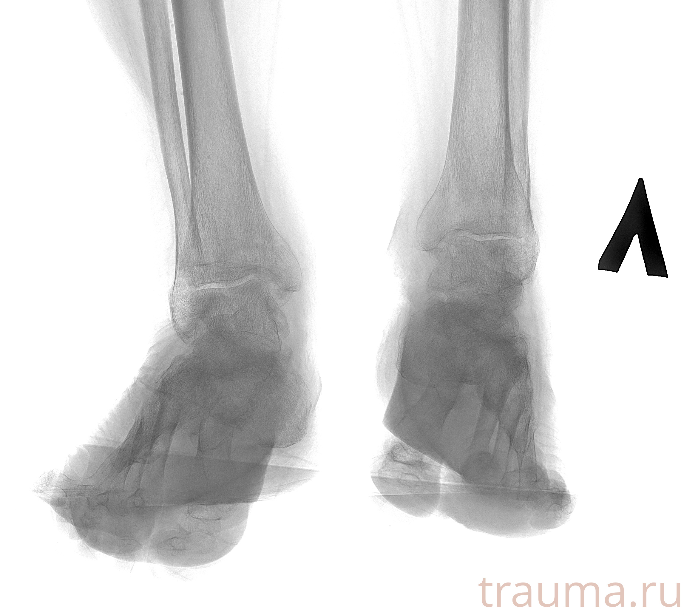 Рентген на дому: по вашему адресу приезжает врач-рентгенолог, травматолог-ортопед с мобильным рентгеновским аппаратом, проводит диагностику травмы или заболевания, делает необходимые рентгенограммы, дает рекомендации по дальнейшему лечению. Получить качественные снимки в домашних условиях возможно благодаря уникальной методике, разработанной МосРентген Центром для института  Склифосовского