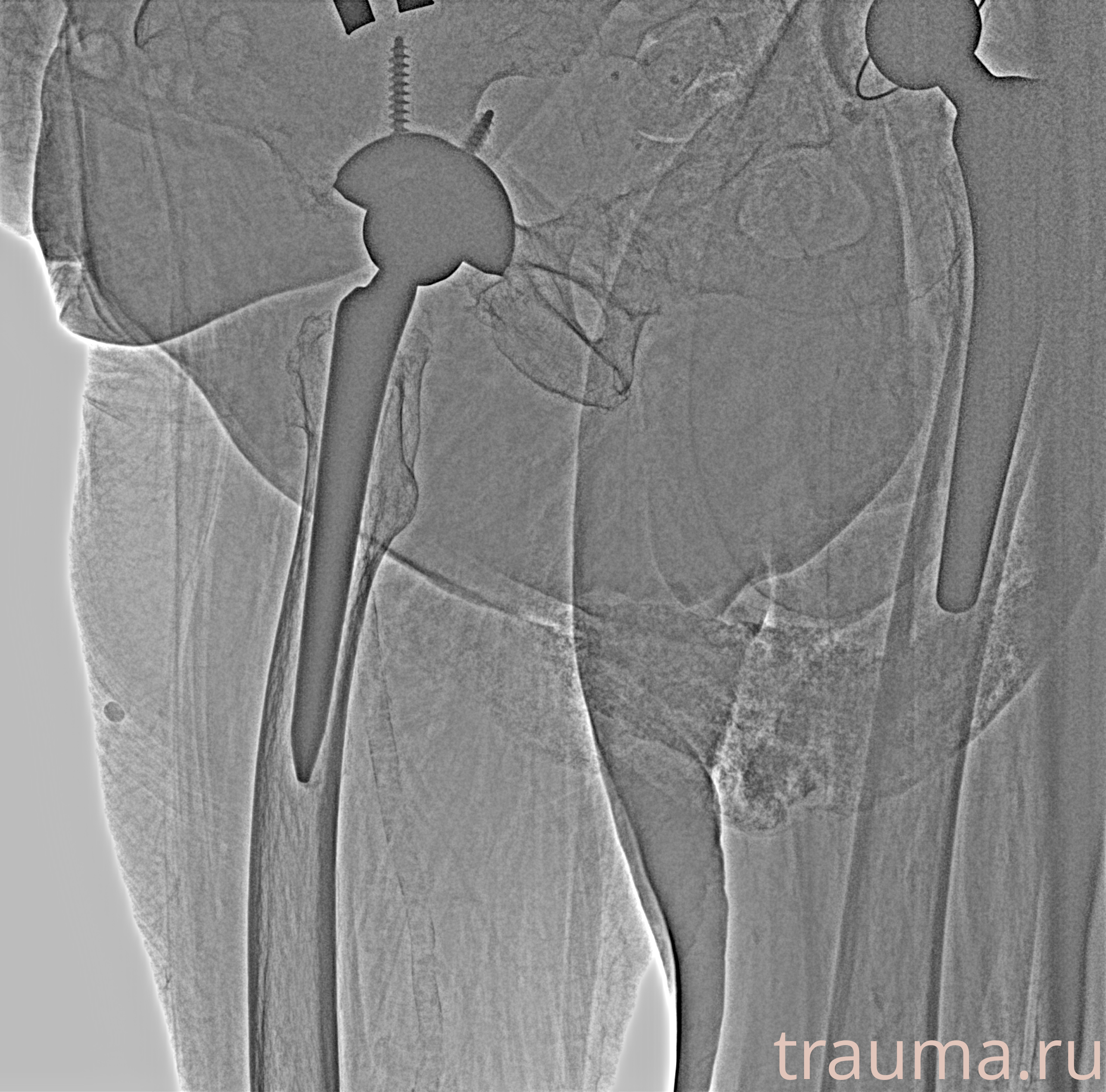 Рентген на дому: по вашему адресу приезжает врач-рентгенолог, травматолог-ортопед с мобильным рентгеновским аппаратом, проводит диагностику травмы или заболевания, делает необходимые рентгенограммы, дает рекомендации по дальнейшему лечению. Получить качественные снимки в домашних условиях возможно благодаря уникальной методике, разработанной МосРентген Центром для института  Склифосовского