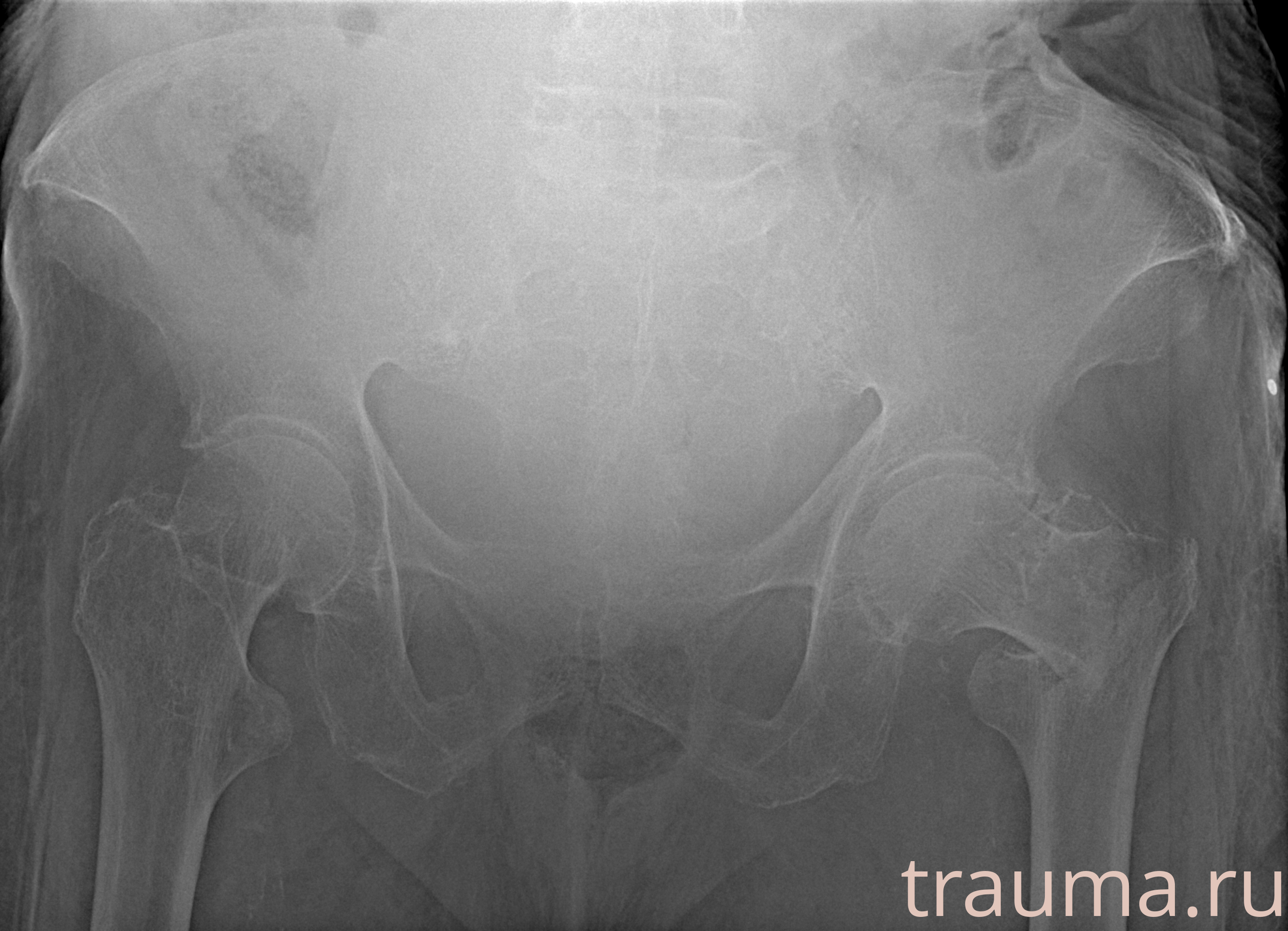 Рентген на дому: по вашему адресу приезжает врач-рентгенолог, травматолог-ортопед с мобильным рентгеновским аппаратом, проводит диагностику травмы или заболевания, делает необходимые рентгенограммы, дает рекомендации по дальнейшему лечению. Получить качественные снимки в домашних условиях возможно благодаря уникальной методике, разработанной МосРентген Центром для института  Склифосовского