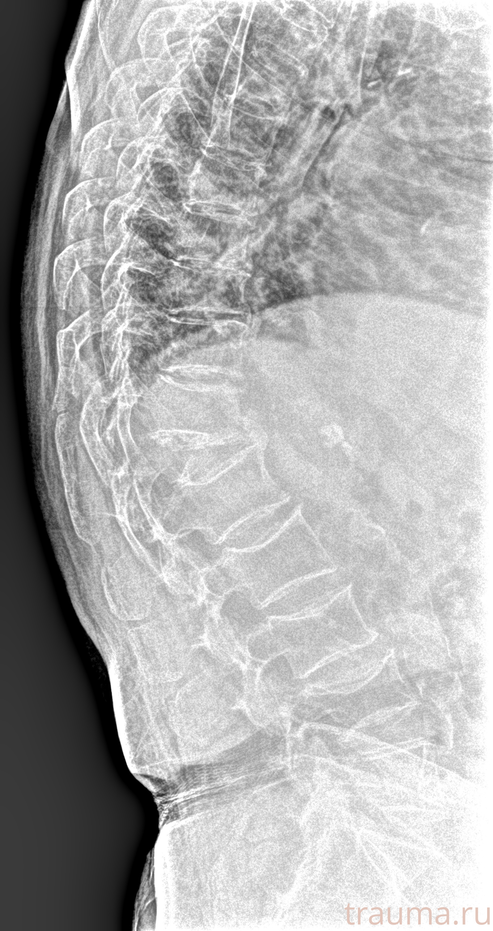 Рентген на дому: по вашему адресу приезжает врач-рентгенолог, травматолог-ортопед с мобильным рентгеновским аппаратом, проводит диагностику травмы или заболевания, делает необходимые рентгенограммы, дает рекомендации по дальнейшему лечению. Получить качественные снимки в домашних условиях возможно благодаря уникальной методике, разработанной МосРентген Центром для института  Склифосовского