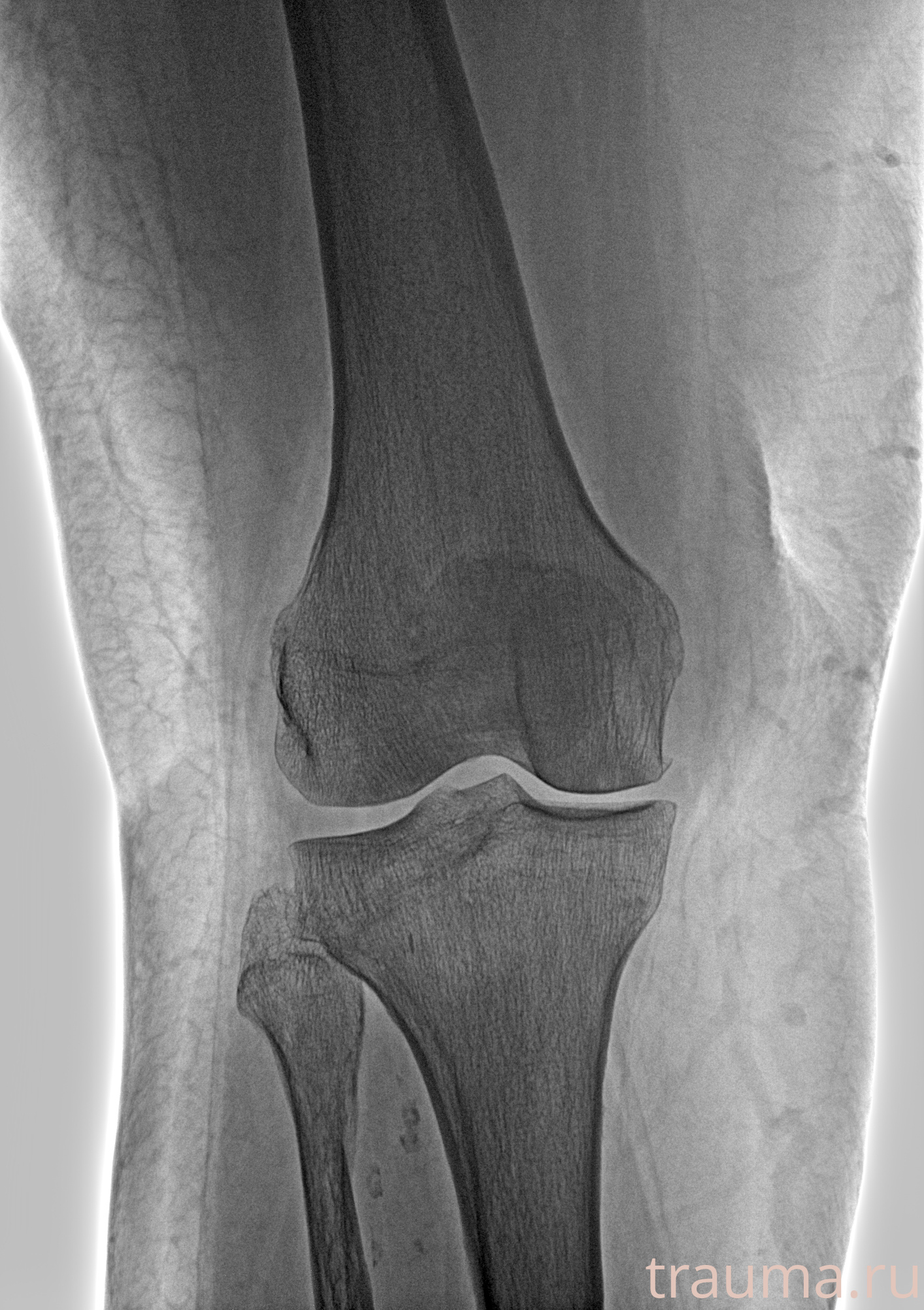 Рентген на дому: по вашему адресу приезжает врач-рентгенолог, травматолог-ортопед с мобильным рентгеновским аппаратом, проводит диагностику травмы или заболевания, делает необходимые рентгенограммы, дает рекомендации по дальнейшему лечению. Получить качественные снимки в домашних условиях возможно благодаря уникальной методике, разработанной МосРентген Центром для института  Склифосовского