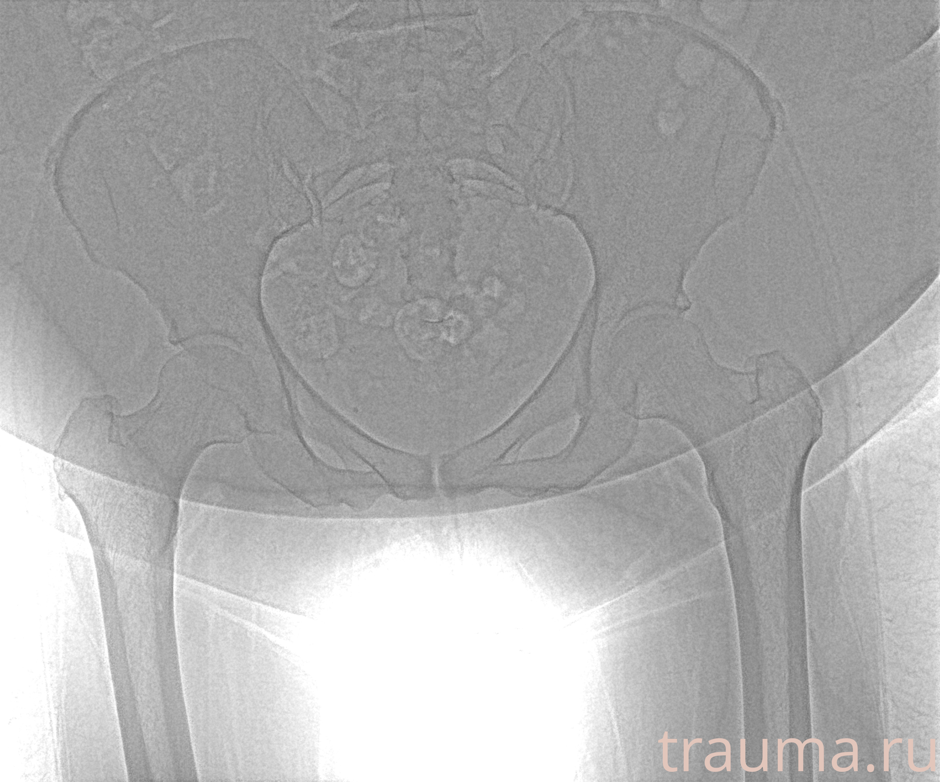 Рентген на дому: по вашему адресу приезжает врач-рентгенолог, травматолог-ортопед с мобильным рентгеновским аппаратом, проводит диагностику травмы или заболевания, делает необходимые рентгенограммы, дает рекомендации по дальнейшему лечению. Получить качественные снимки в домашних условиях возможно благодаря уникальной методике, разработанной МосРентген Центром для института  Склифосовского