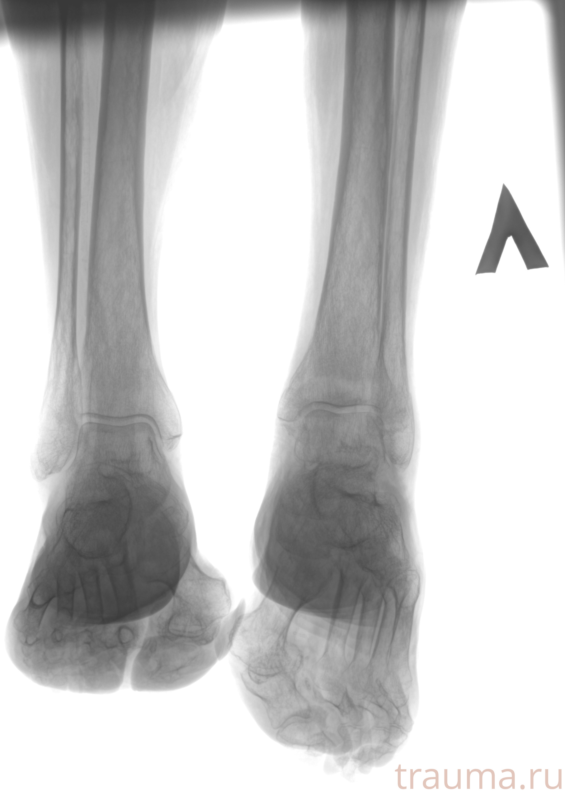Рентген на дому: по вашему адресу приезжает врач-рентгенолог, травматолог-ортопед с мобильным рентгеновским аппаратом, проводит диагностику травмы или заболевания, делает необходимые рентгенограммы, дает рекомендации по дальнейшему лечению. Получить качественные снимки в домашних условиях возможно благодаря уникальной методике, разработанной МосРентген Центром для института  Склифосовского