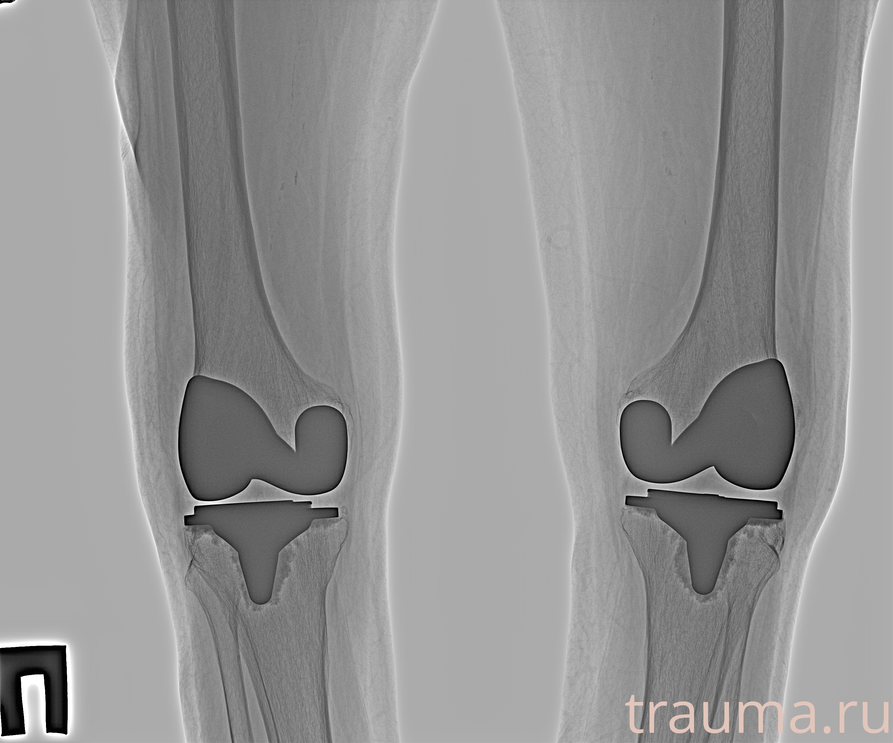 Рентген на дому: по вашему адресу приезжает врач-рентгенолог, травматолог-ортопед с мобильным рентгеновским аппаратом, проводит диагностику травмы или заболевания, делает необходимые рентгенограммы, дает рекомендации по дальнейшему лечению. Получить качественные снимки в домашних условиях возможно благодаря уникальной методике, разработанной МосРентген Центром для института  Склифосовского