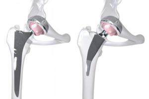 Влияние бариатрических операций на результаты тотального эндопротезирования при коксартрозе
