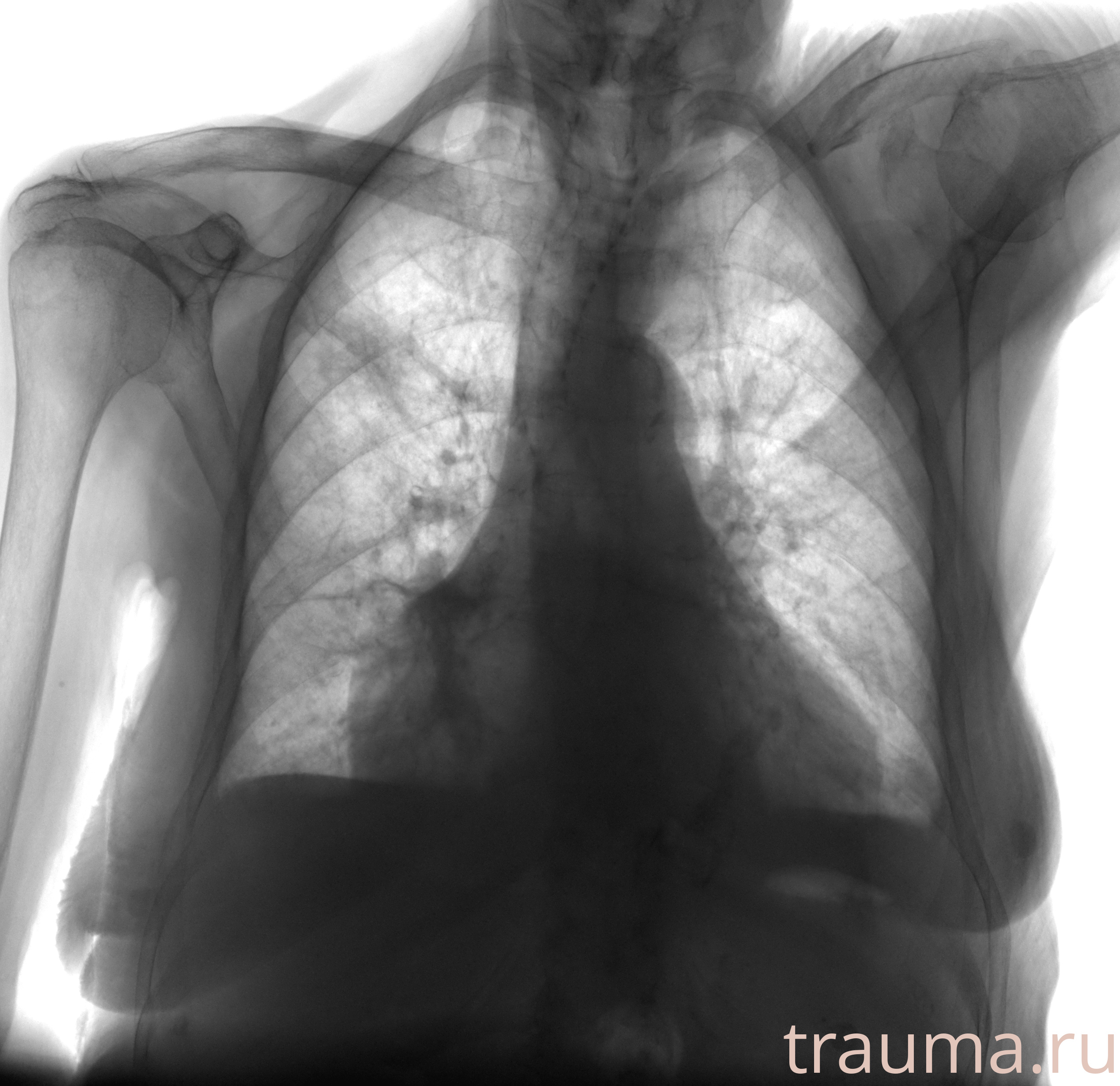 Рентген на дому: по вашему адресу приезжает врач-рентгенолог, травматолог-ортопед с мобильным рентгеновским аппаратом, проводит диагностику травмы или заболевания, делает необходимые рентгенограммы, дает рекомендации по дальнейшему лечению. Получить качественные снимки в домашних условиях возможно благодаря уникальной методике, разработанной МосРентген Центром для института  Склифосовского