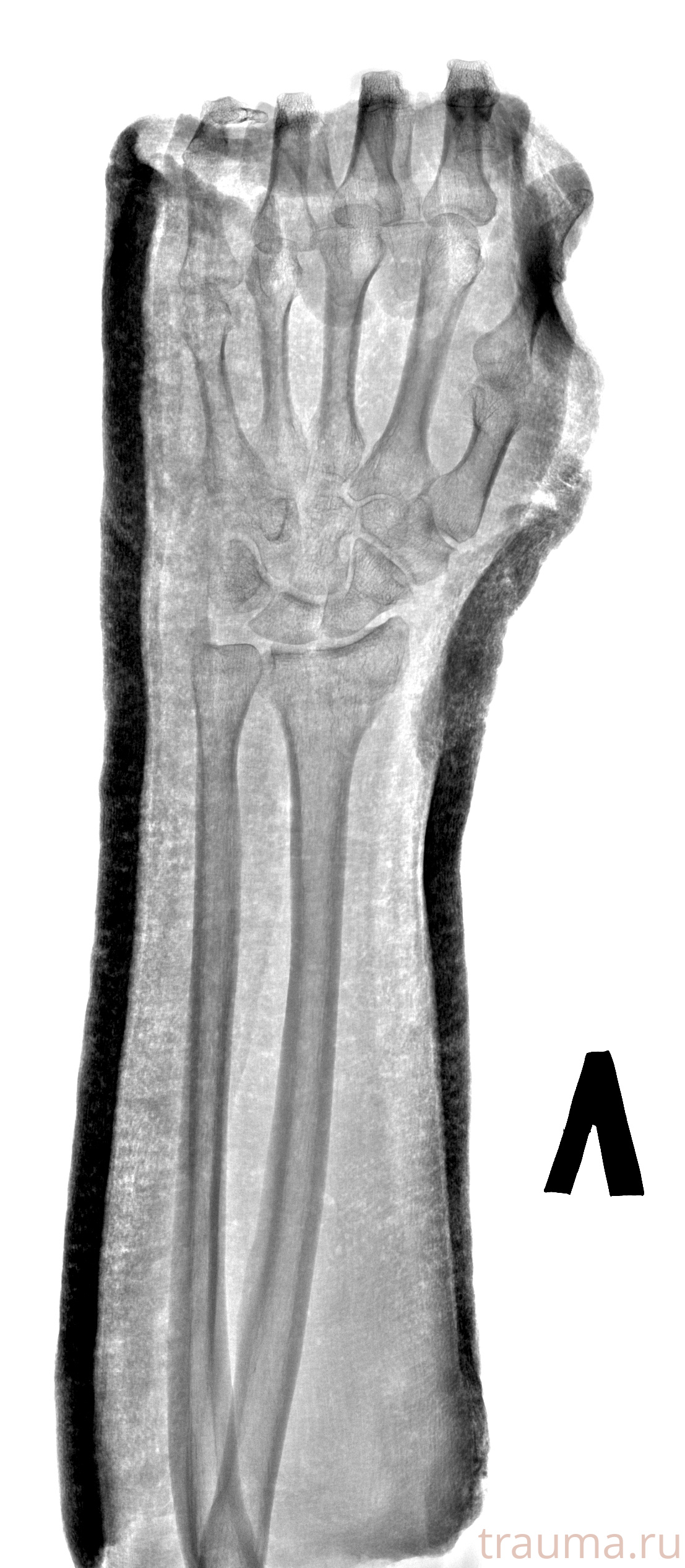 Рентген на дому: по вашему адресу приезжает врач-рентгенолог, травматолог-ортопед с мобильным рентгеновским аппаратом, проводит диагностику травмы или заболевания, делает необходимые рентгенограммы, дает рекомендации по дальнейшему лечению. Получить качественные снимки в домашних условиях возможно благодаря уникальной методике, разработанной МосРентген Центром для института  Склифосовского