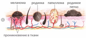 Базальноклеточный рак кожи
Базальноклеточный рак кожи