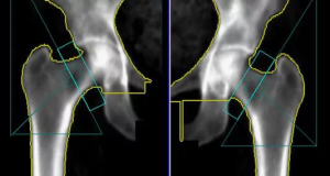 Рентгенография и рентгенологические измерения бедренной кости на основе методологии CORA. Часть 1. Измерения бедренной кости во фронтальной плоскости