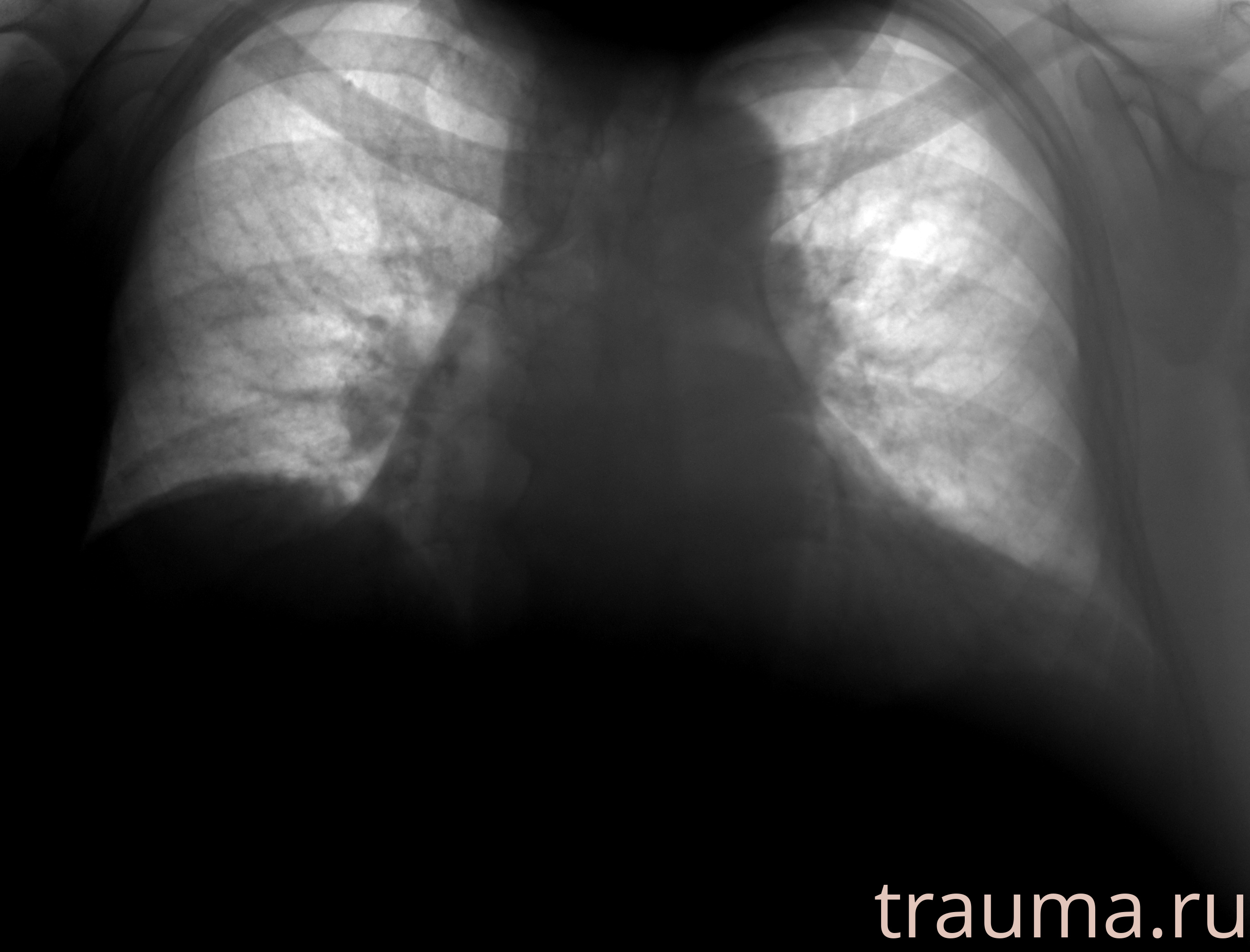 Рентген на дому: по вашему адресу приезжает врач-рентгенолог, травматолог-ортопед с мобильным рентгеновским аппаратом, проводит диагностику травмы или заболевания, делает необходимые рентгенограммы, дает рекомендации по дальнейшему лечению. Получить качественные снимки в домашних условиях возможно благодаря уникальной методике, разработанной МосРентген Центром для института  Склифосовского