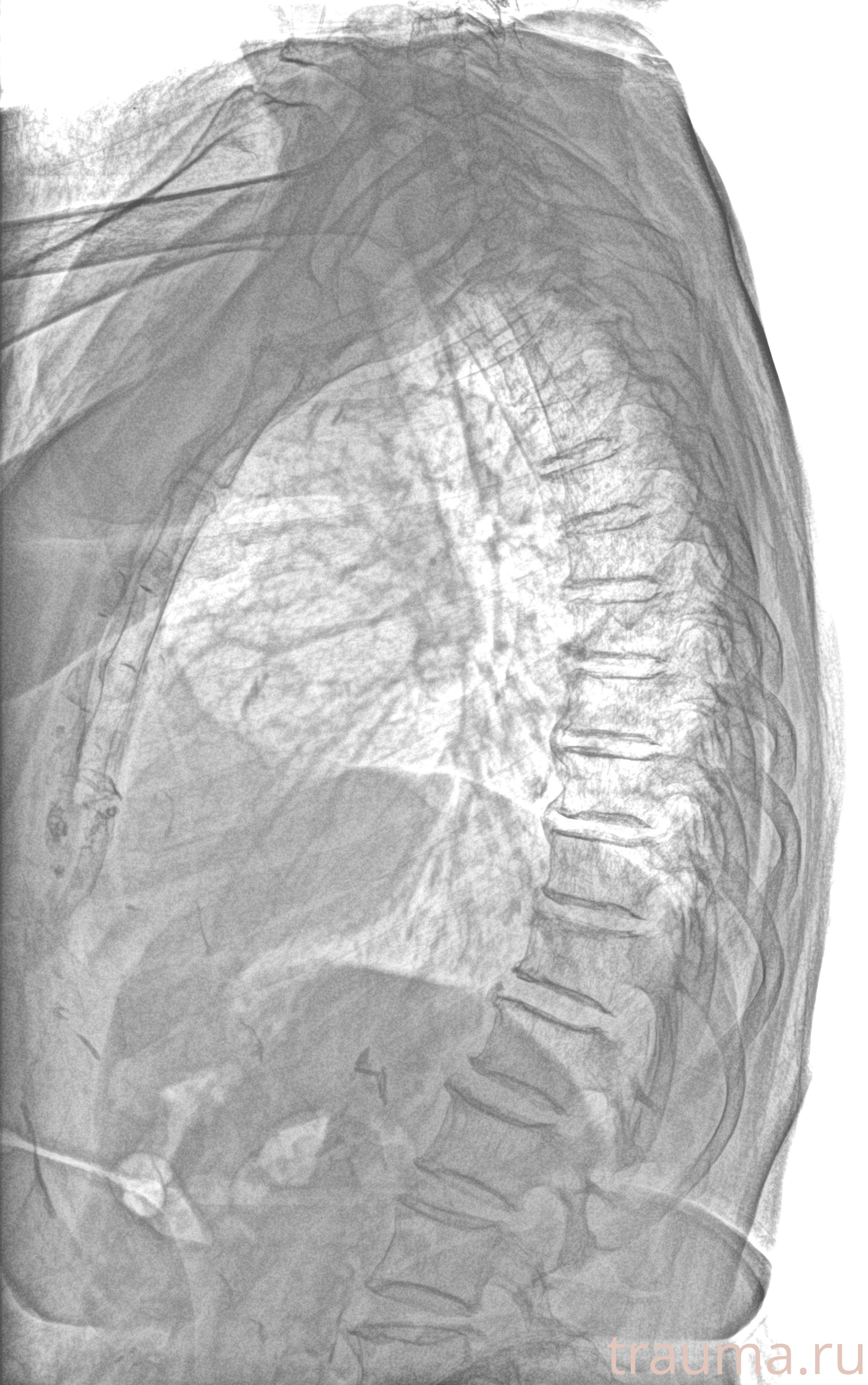 Рентген на дому: по вашему адресу приезжает врач-рентгенолог, травматолог-ортопед с мобильным рентгеновским аппаратом, проводит диагностику травмы или заболевания, делает необходимые рентгенограммы, дает рекомендации по дальнейшему лечению. Получить качественные снимки в домашних условиях возможно благодаря уникальной методике, разработанной МосРентген Центром для института  Склифосовского