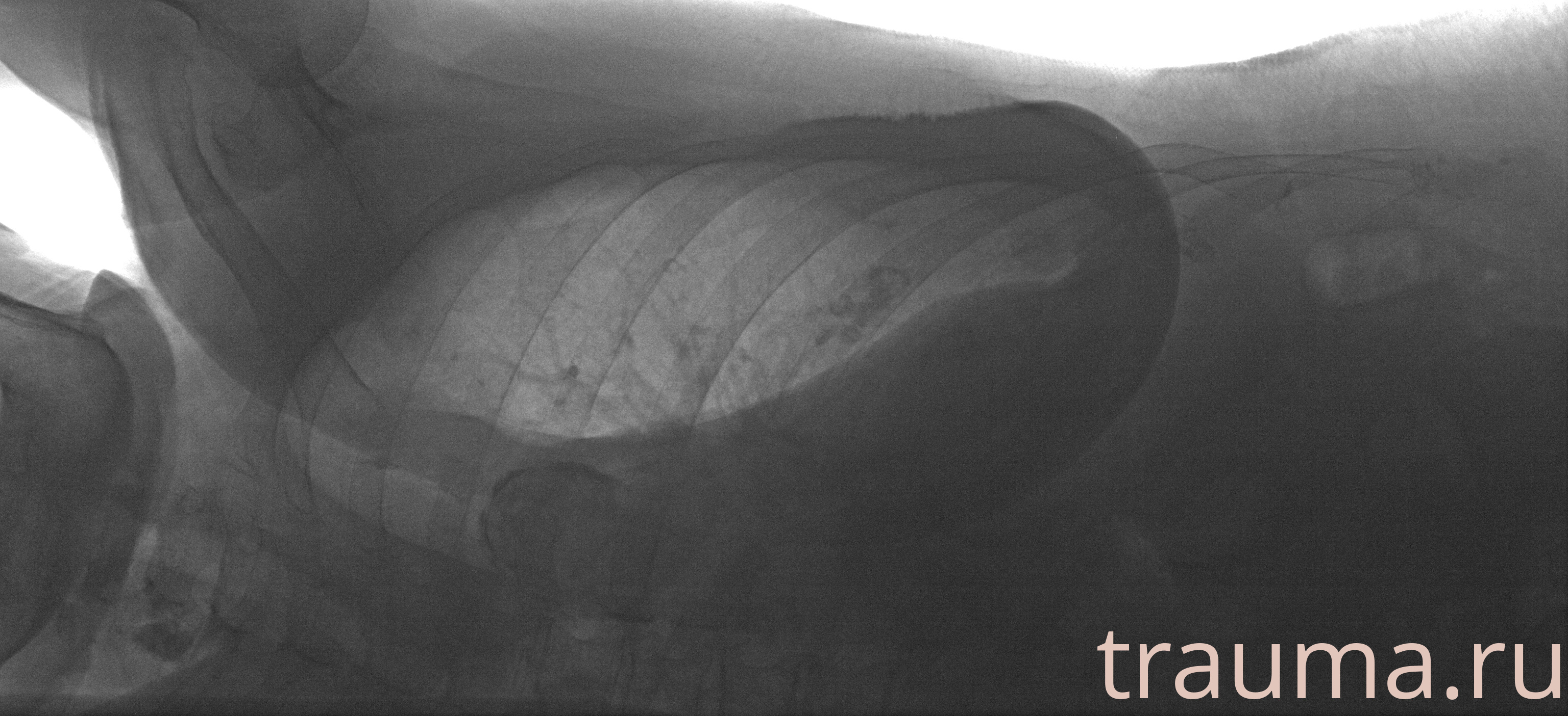 Рентген на дому: по вашему адресу приезжает врач-рентгенолог, травматолог-ортопед с мобильным рентгеновским аппаратом, проводит диагностику травмы или заболевания, делает необходимые рентгенограммы, дает рекомендации по дальнейшему лечению. Получить качественные снимки в домашних условиях возможно благодаря уникальной методике, разработанной МосРентген Центром для института  Склифосовского