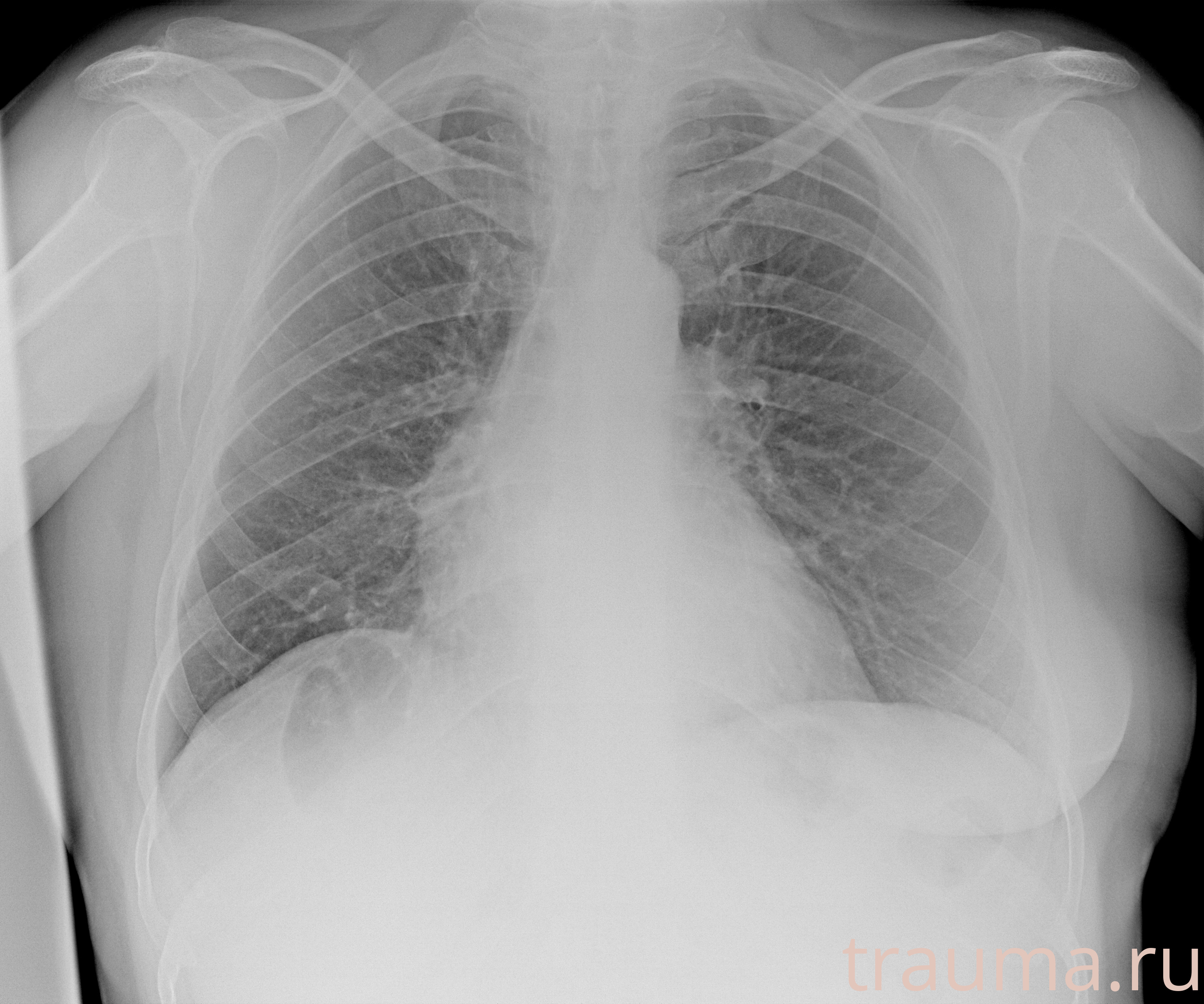 Рентген на дому: по вашему адресу приезжает врач-рентгенолог, травматолог-ортопед с мобильным рентгеновским аппаратом, проводит диагностику травмы или заболевания, делает необходимые рентгенограммы, дает рекомендации по дальнейшему лечению. Получить качественные снимки в домашних условиях возможно благодаря уникальной методике, разработанной МосРентген Центром для института  Склифосовского