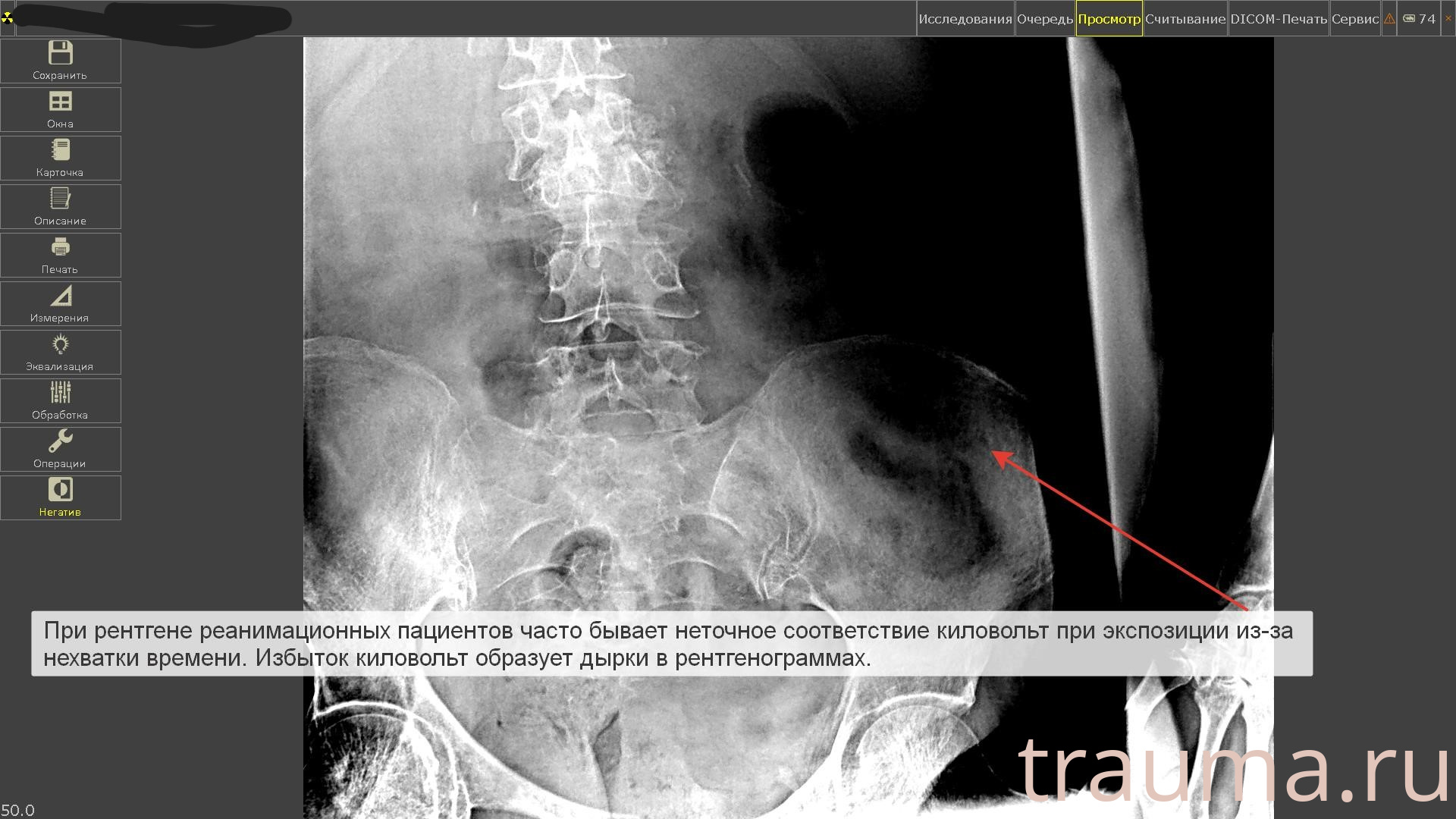 Рентген на дому: по вашему адресу приезжает врач-рентгенолог, травматолог-ортопед с мобильным рентгеновским аппаратом, проводит диагностику травмы или заболевания, делает необходимые рентгенограммы, дает рекомендации по дальнейшему лечению. Получить качественные снимки в домашних условиях возможно благодаря уникальной методике, разработанной МосРентген Центром для института  Склифосовского