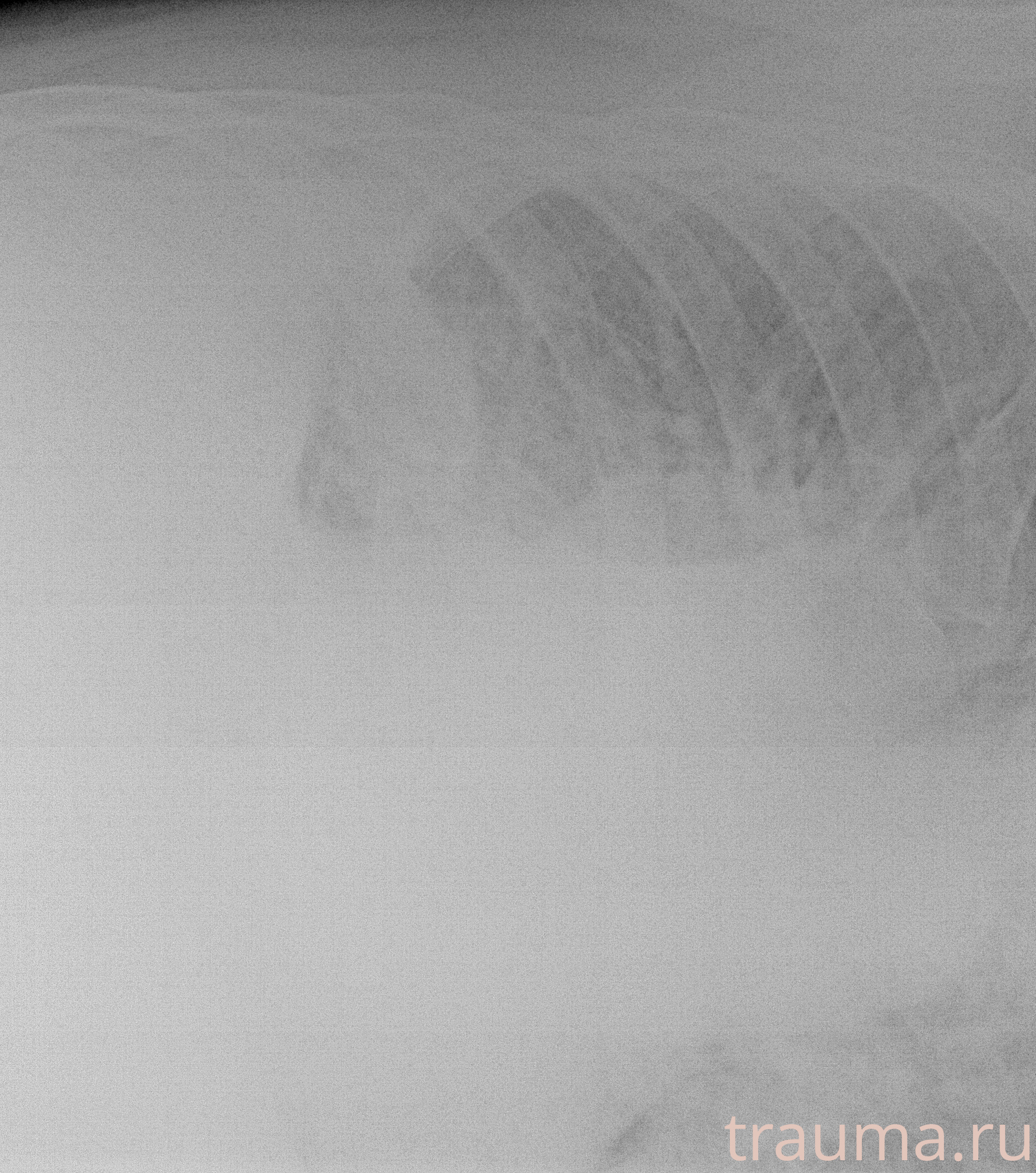 Рентген на дому: по вашему адресу приезжает врач-рентгенолог, травматолог-ортопед с мобильным рентгеновским аппаратом, проводит диагностику травмы или заболевания, делает необходимые рентгенограммы, дает рекомендации по дальнейшему лечению. Получить качественные снимки в домашних условиях возможно благодаря уникальной методике, разработанной МосРентген Центром для института  Склифосовского