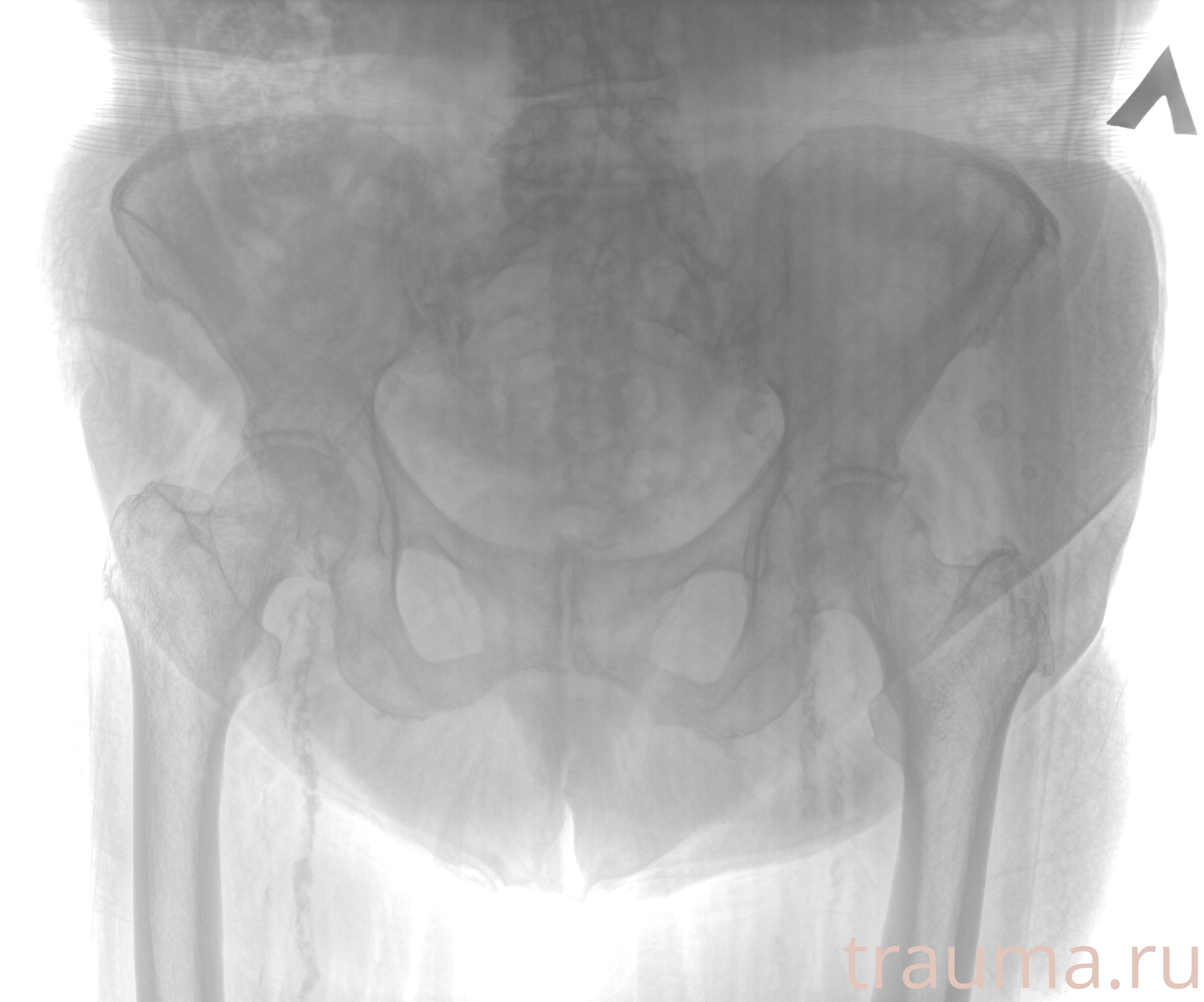 Рентген на дому: по вашему адресу приезжает врач-рентгенолог, травматолог-ортопед с мобильным рентгеновским аппаратом, проводит диагностику травмы или заболевания, делает необходимые рентгенограммы, дает рекомендации по дальнейшему лечению. Получить качественные снимки в домашних условиях возможно благодаря уникальной методике, разработанной МосРентген Центром для института  Склифосовского