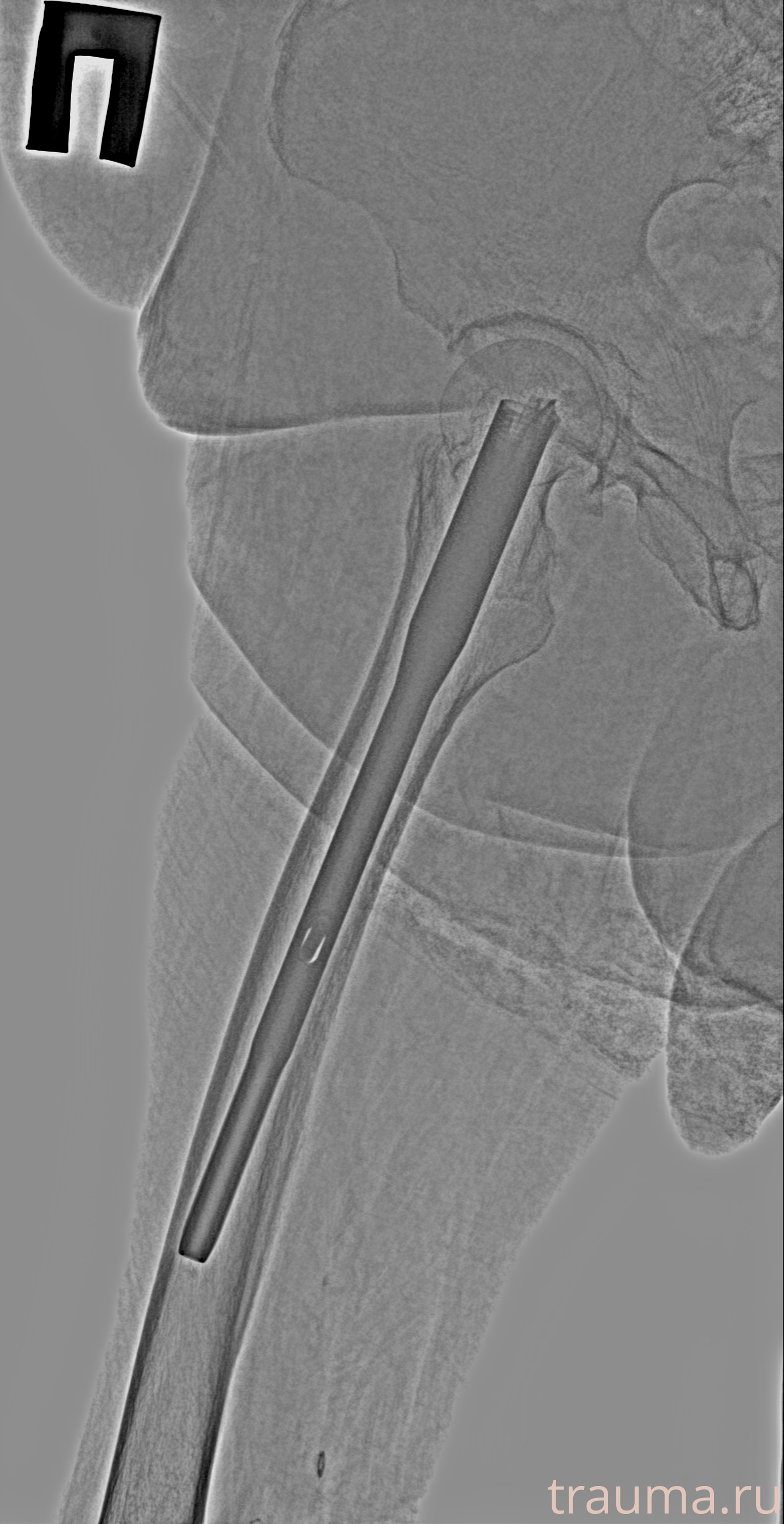 Рентген на дому: по вашему адресу приезжает врач-рентгенолог, травматолог-ортопед с мобильным рентгеновским аппаратом, проводит диагностику травмы или заболевания, делает необходимые рентгенограммы, дает рекомендации по дальнейшему лечению. Получить качественные снимки в домашних условиях возможно благодаря уникальной методике, разработанной МосРентген Центром для института  Склифосовского