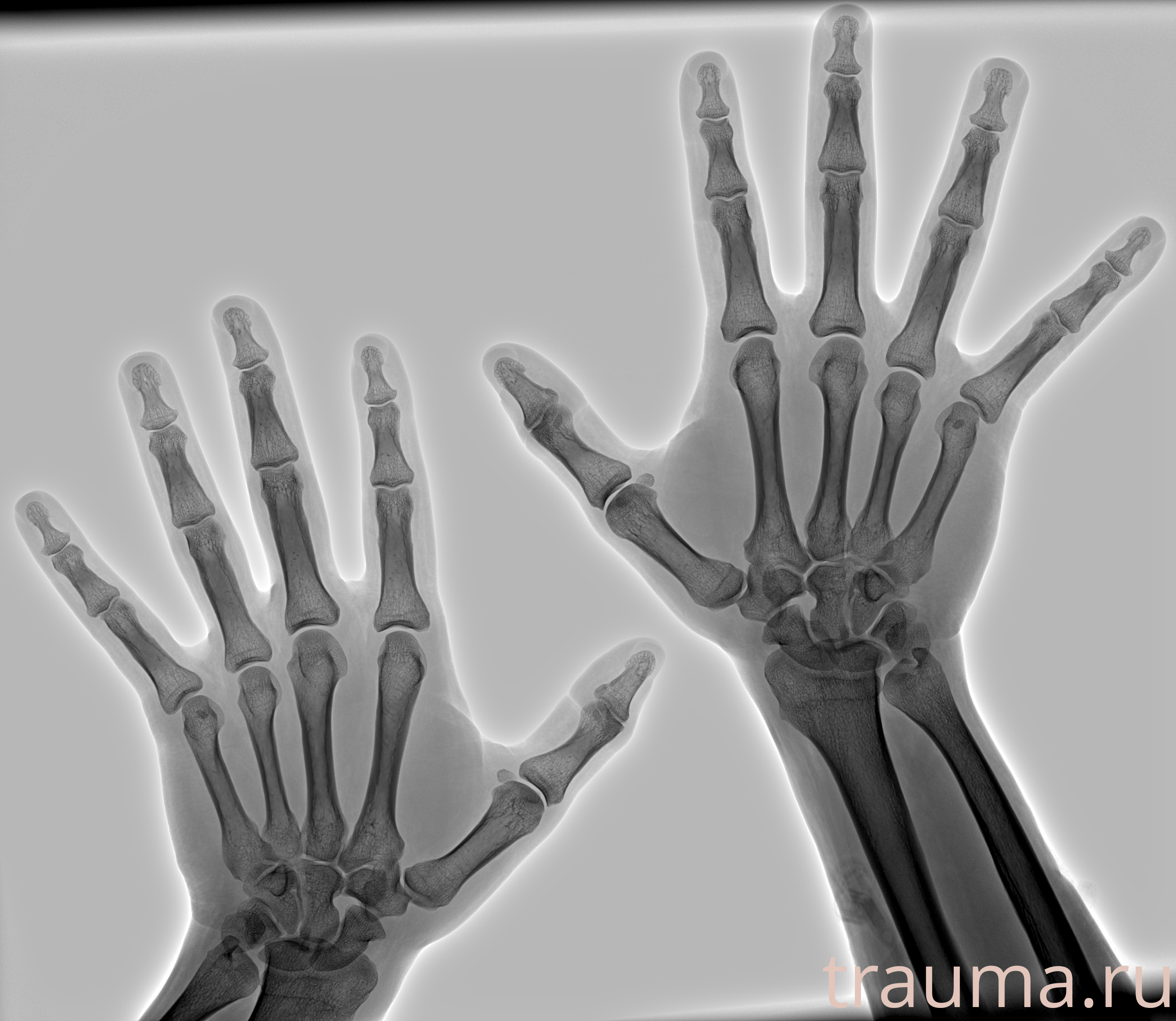 Рентген на дому: по вашему адресу приезжает врач-рентгенолог, травматолог-ортопед с мобильным рентгеновским аппаратом, проводит диагностику травмы или заболевания, делает необходимые рентгенограммы, дает рекомендации по дальнейшему лечению. Получить качественные снимки в домашних условиях возможно благодаря уникальной методике, разработанной МосРентген Центром для института  Склифосовского