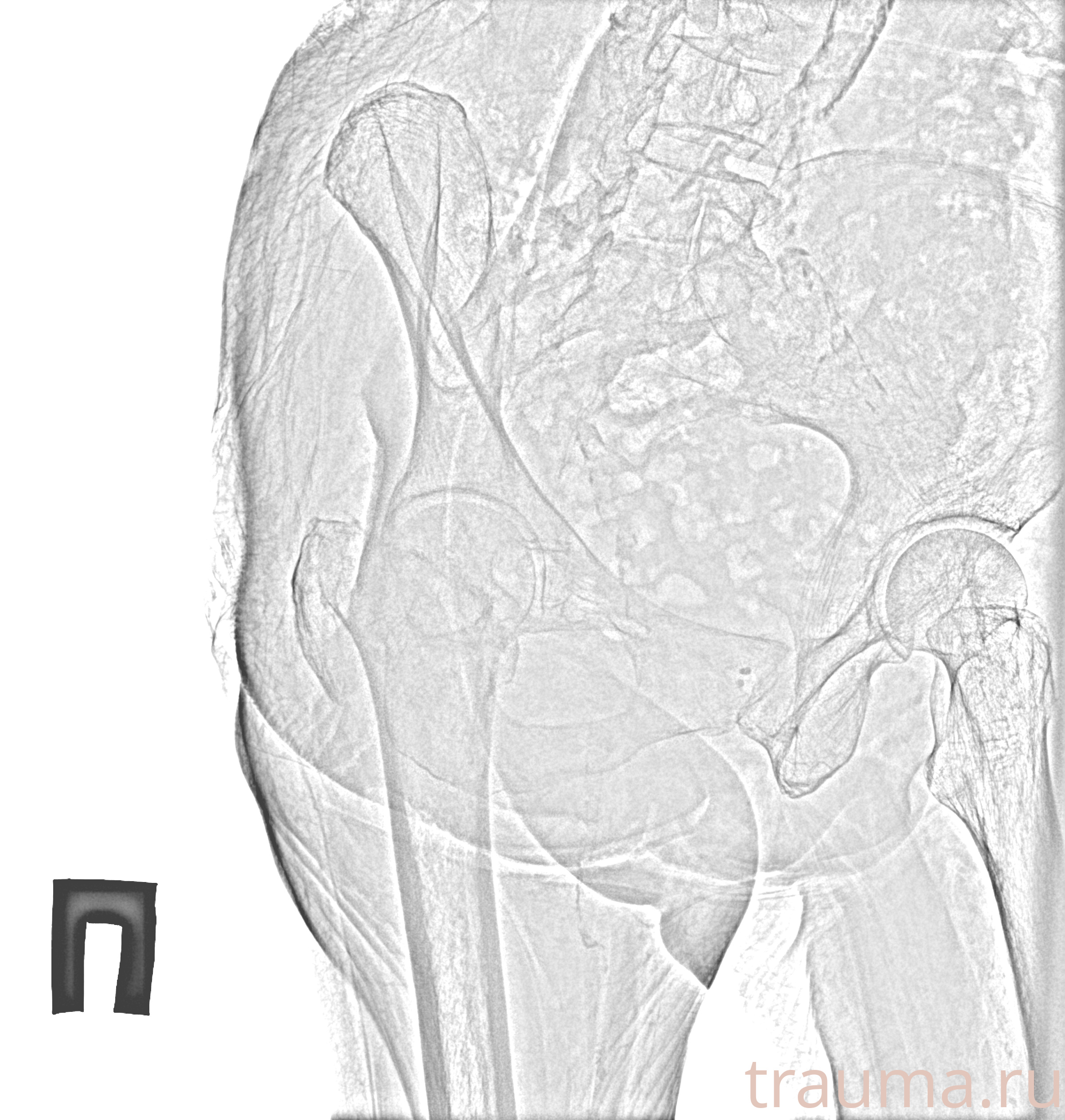 Рентген на дому: по вашему адресу приезжает врач-рентгенолог, травматолог-ортопед с мобильным рентгеновским аппаратом, проводит диагностику травмы или заболевания, делает необходимые рентгенограммы, дает рекомендации по дальнейшему лечению. Получить качественные снимки в домашних условиях возможно благодаря уникальной методике, разработанной МосРентген Центром для института  Склифосовского