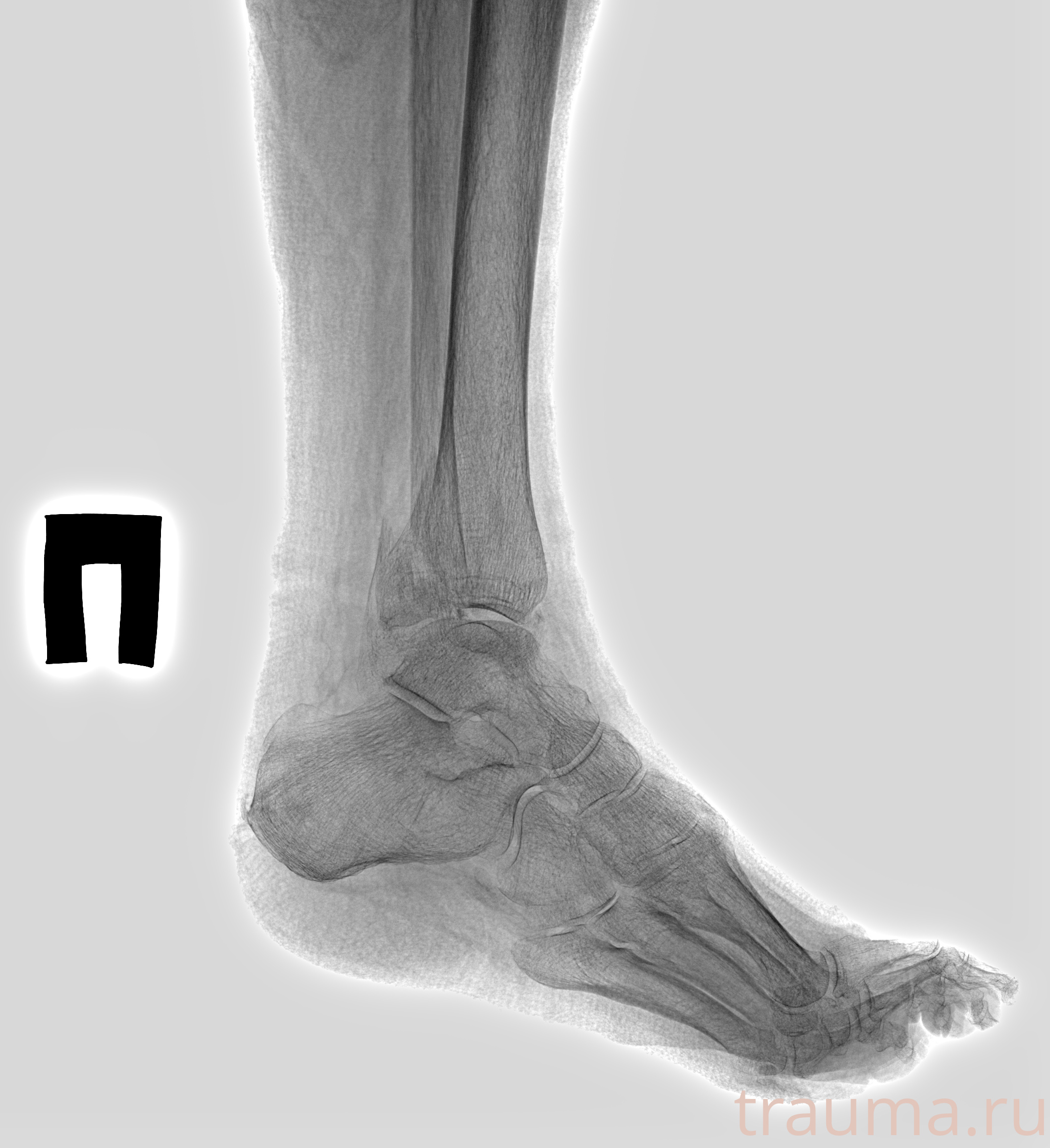 Рентген на дому: по вашему адресу приезжает врач-рентгенолог, травматолог-ортопед с мобильным рентгеновским аппаратом, проводит диагностику травмы или заболевания, делает необходимые рентгенограммы, дает рекомендации по дальнейшему лечению. Получить качественные снимки в домашних условиях возможно благодаря уникальной методике, разработанной МосРентген Центром для института  Склифосовского