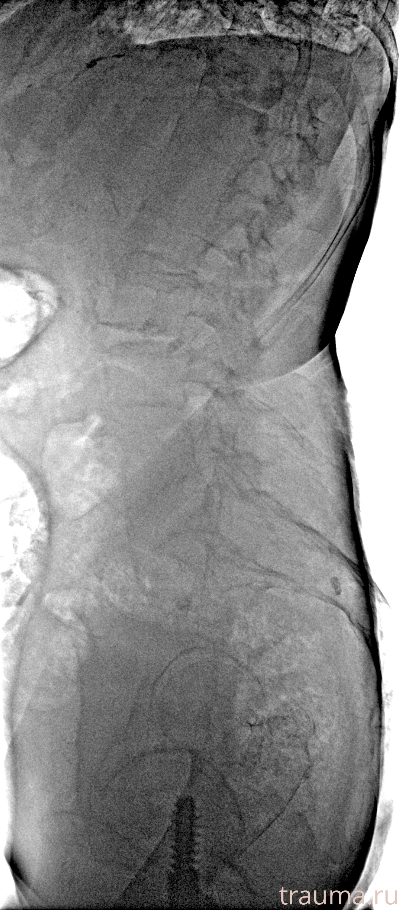 Рентген на дому: по вашему адресу приезжает врач-рентгенолог, травматолог-ортопед с мобильным рентгеновским аппаратом, проводит диагностику травмы или заболевания, делает необходимые рентгенограммы, дает рекомендации по дальнейшему лечению. Получить качественные снимки в домашних условиях возможно благодаря уникальной методике, разработанной МосРентген Центром для института  Склифосовского