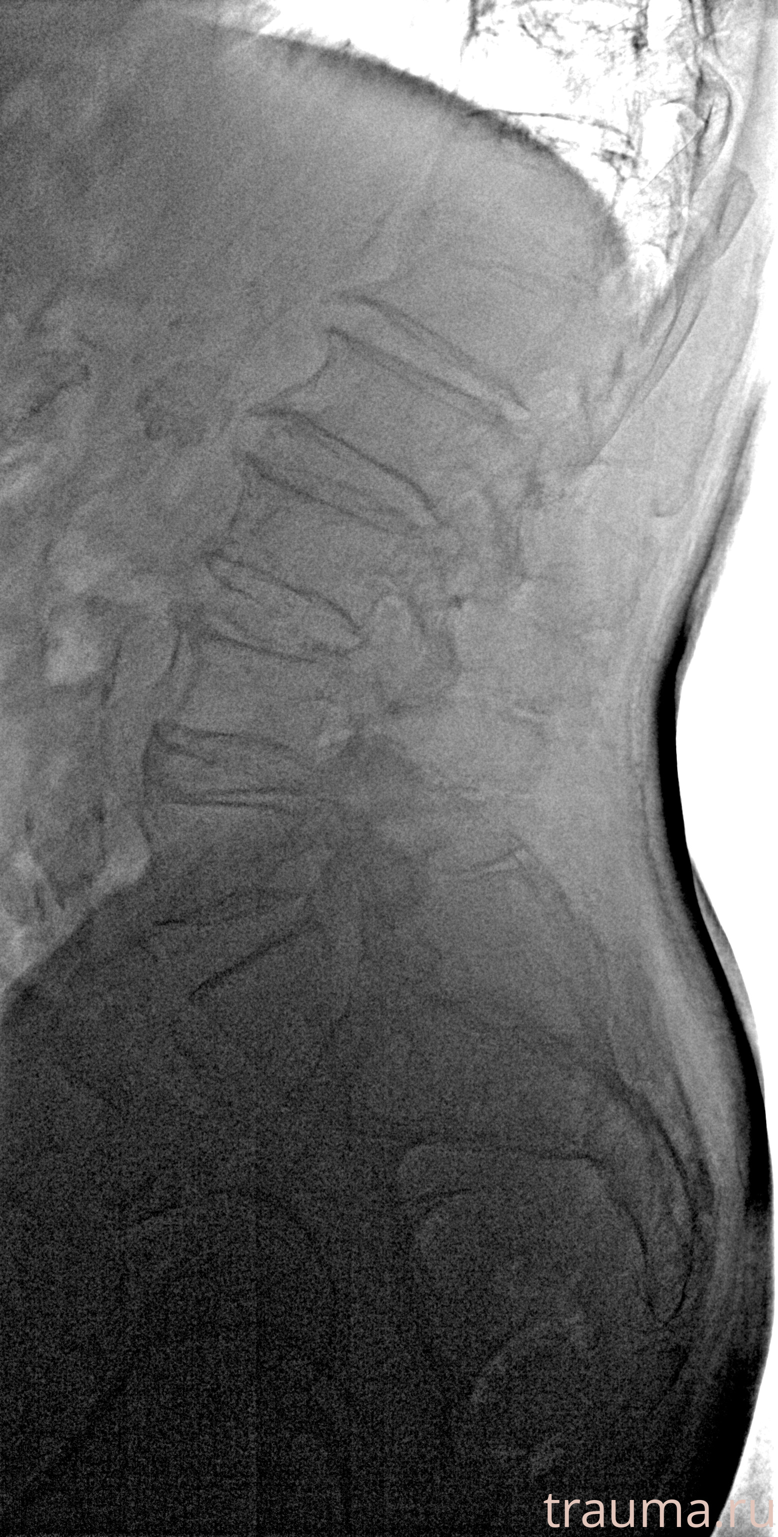 Рентген на дому: по вашему адресу приезжает врач-рентгенолог, травматолог-ортопед с мобильным рентгеновским аппаратом, проводит диагностику травмы или заболевания, делает необходимые рентгенограммы, дает рекомендации по дальнейшему лечению. Получить качественные снимки в домашних условиях возможно благодаря уникальной методике, разработанной МосРентген Центром для института  Склифосовского