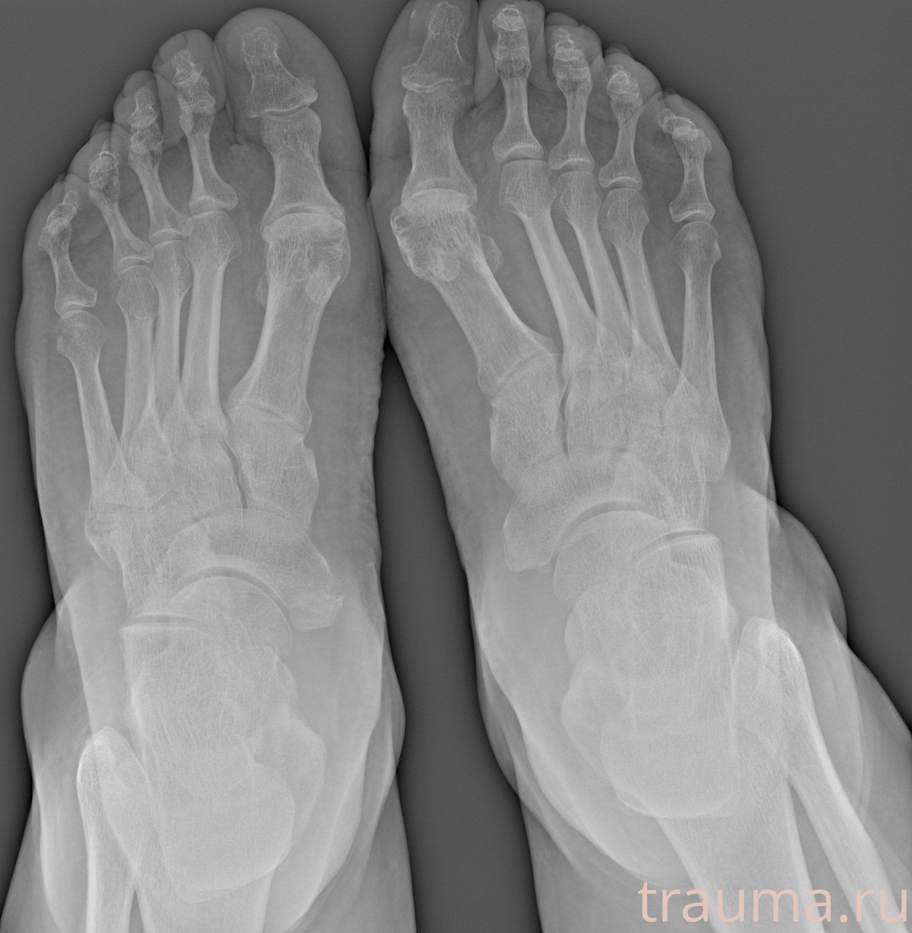 Рентген на дому: по вашему адресу приезжает врач-рентгенолог, травматолог-ортопед с мобильным рентгеновским аппаратом, проводит диагностику травмы или заболевания, делает необходимые рентгенограммы, дает рекомендации по дальнейшему лечению. Получить качественные снимки в домашних условиях возможно благодаря уникальной методике, разработанной МосРентген Центром для института  Склифосовского