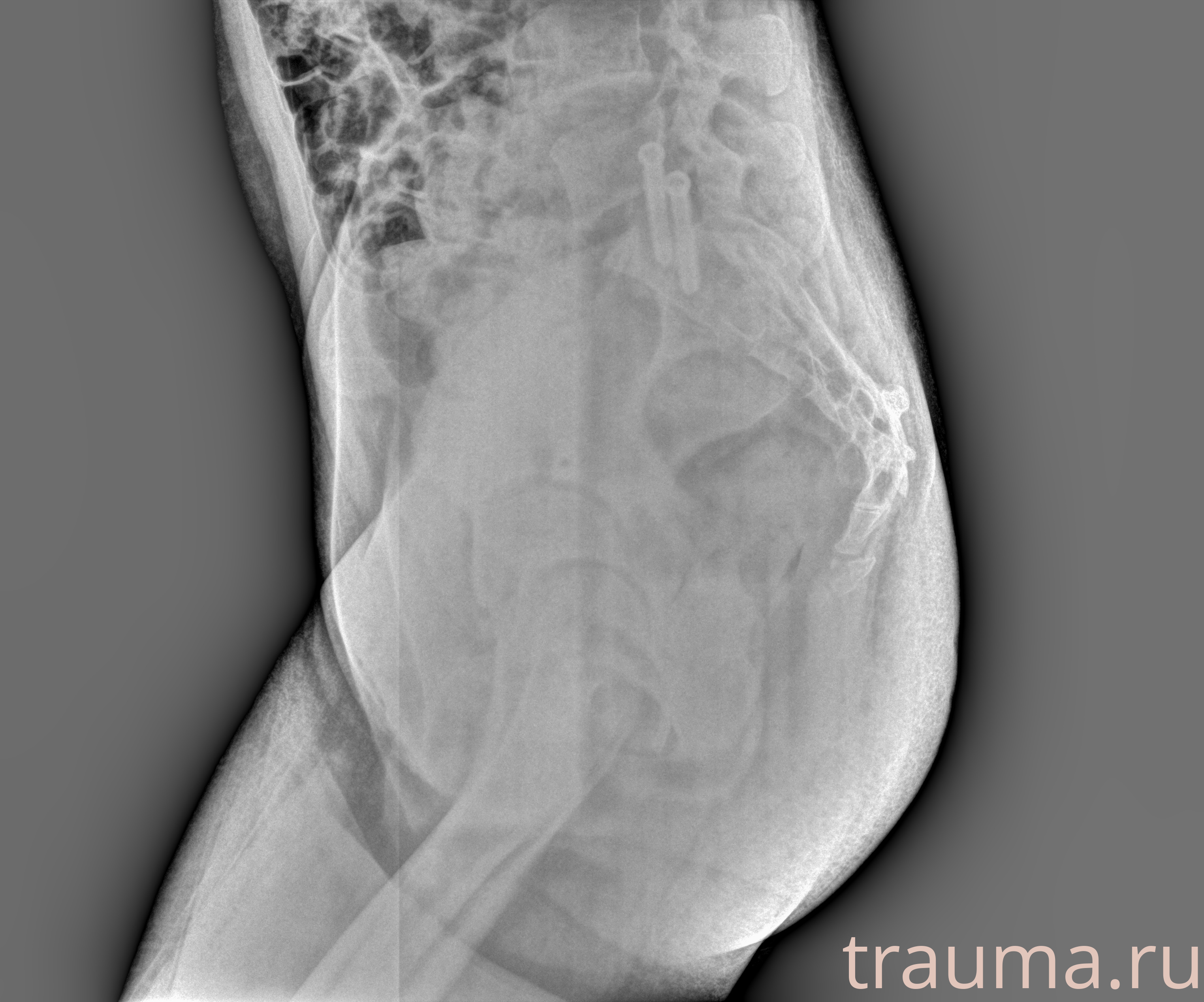 Рентген на дому: по вашему адресу приезжает врач-рентгенолог, травматолог-ортопед с мобильным рентгеновским аппаратом, проводит диагностику травмы или заболевания, делает необходимые рентгенограммы, дает рекомендации по дальнейшему лечению. Получить качественные снимки в домашних условиях возможно благодаря уникальной методике, разработанной МосРентген Центром для института  Склифосовского