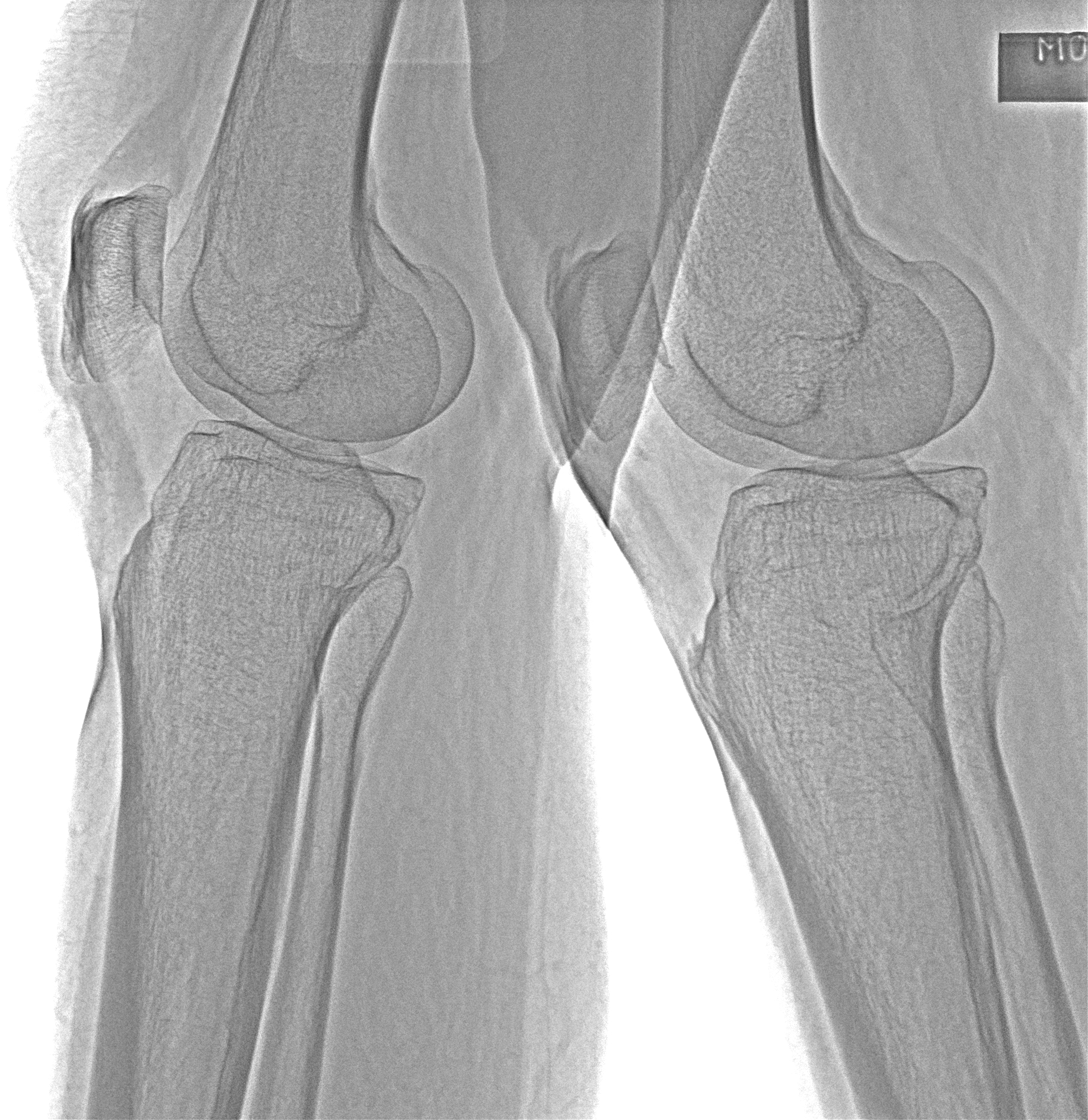 Рентген на дому: по вашему адресу приезжает врач-рентгенолог, травматолог-ортопед с мобильным рентгеновским аппаратом, проводит диагностику травмы или заболевания, делает необходимые рентгенограммы, дает рекомендации по дальнейшему лечению. Получить качественные снимки в домашних условиях возможно благодаря уникальной методике, разработанной МосРентген Центром для института  Склифосовского