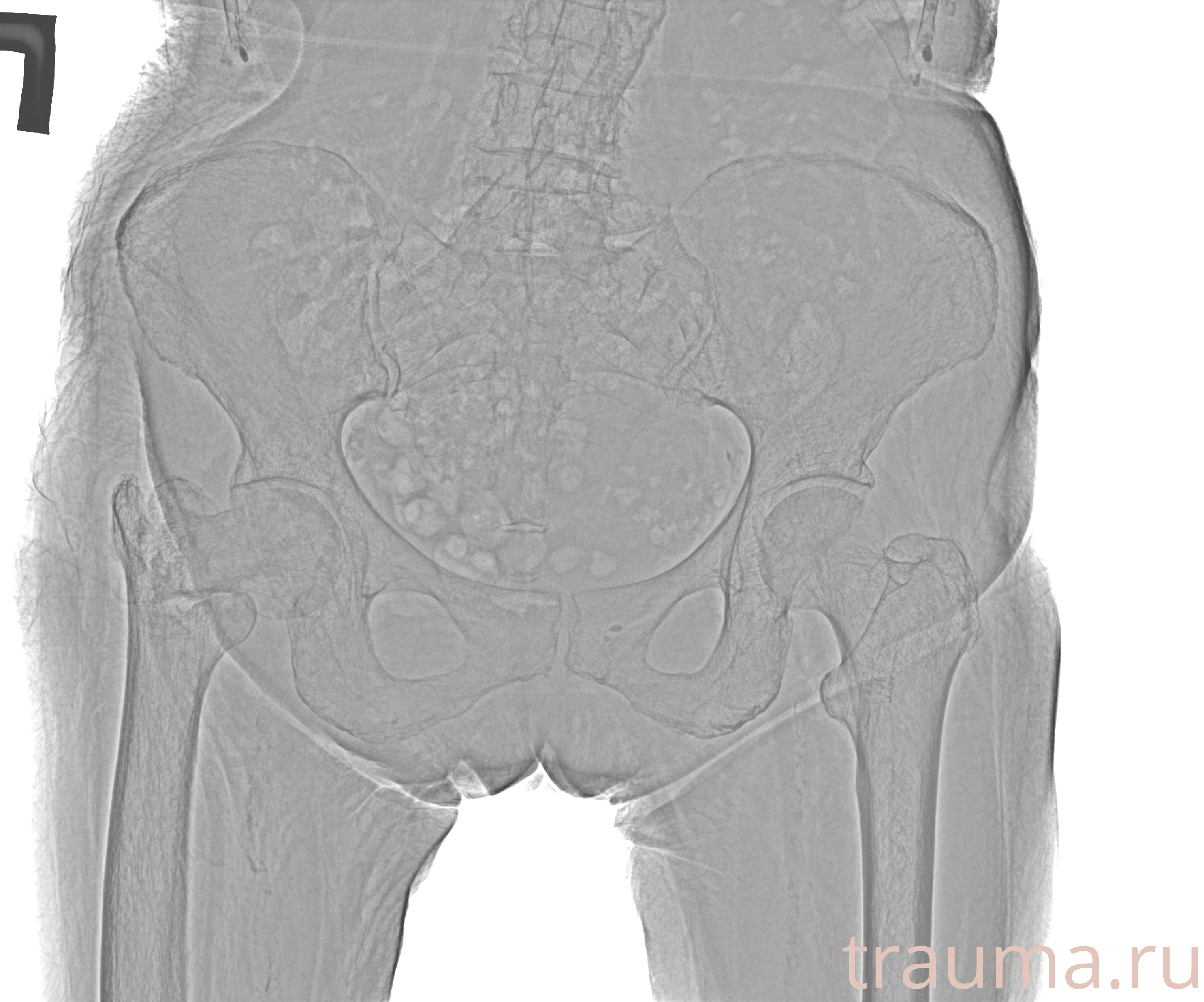 Рентген на дому: по вашему адресу приезжает врач-рентгенолог, травматолог-ортопед с мобильным рентгеновским аппаратом, проводит диагностику травмы или заболевания, делает необходимые рентгенограммы, дает рекомендации по дальнейшему лечению. Получить качественные снимки в домашних условиях возможно благодаря уникальной методике, разработанной МосРентген Центром для института  Склифосовского