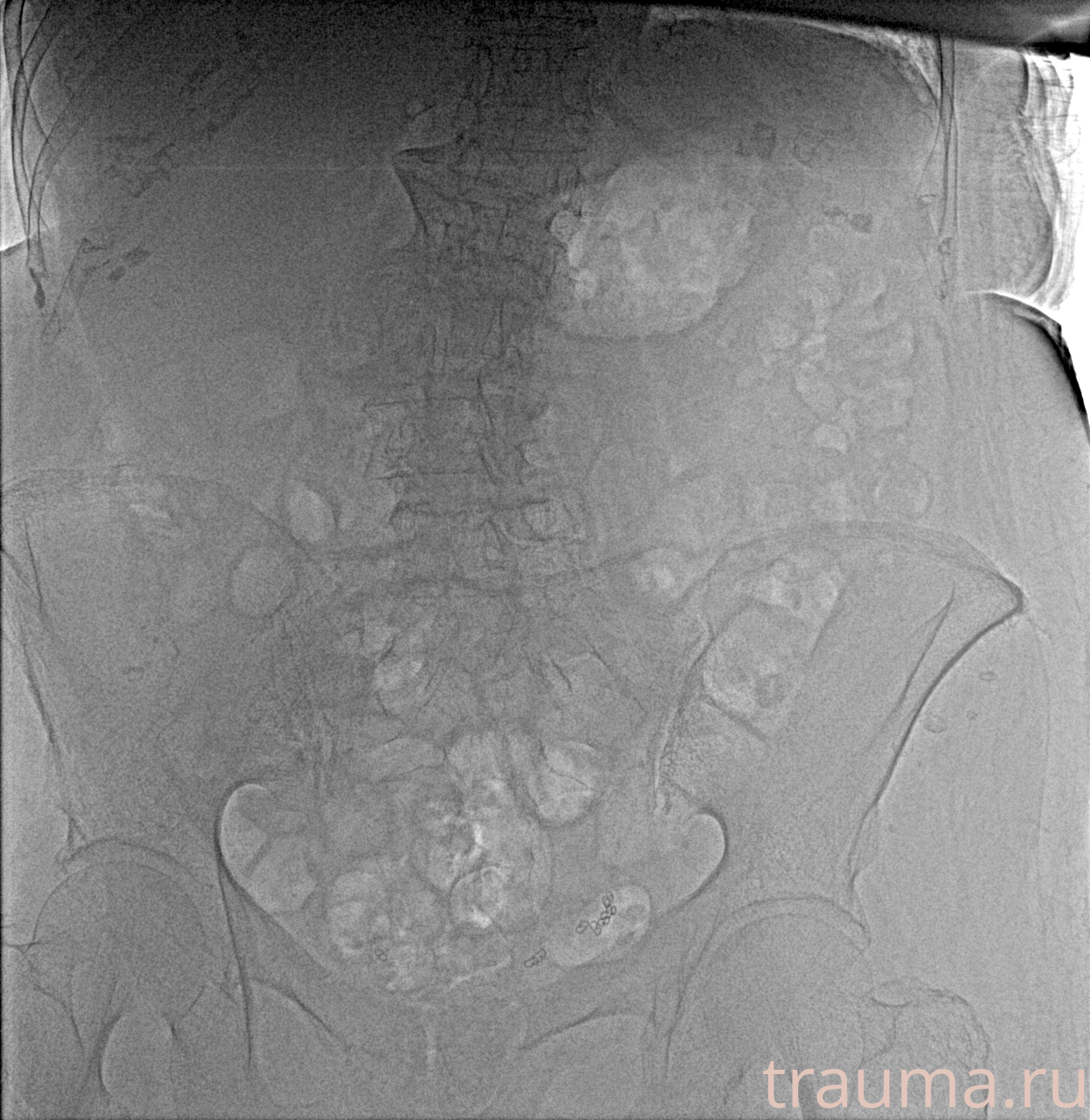 Рентген на дому: по вашему адресу приезжает врач-рентгенолог, травматолог-ортопед с мобильным рентгеновским аппаратом, проводит диагностику травмы или заболевания, делает необходимые рентгенограммы, дает рекомендации по дальнейшему лечению. Получить качественные снимки в домашних условиях возможно благодаря уникальной методике, разработанной МосРентген Центром для института  Склифосовского