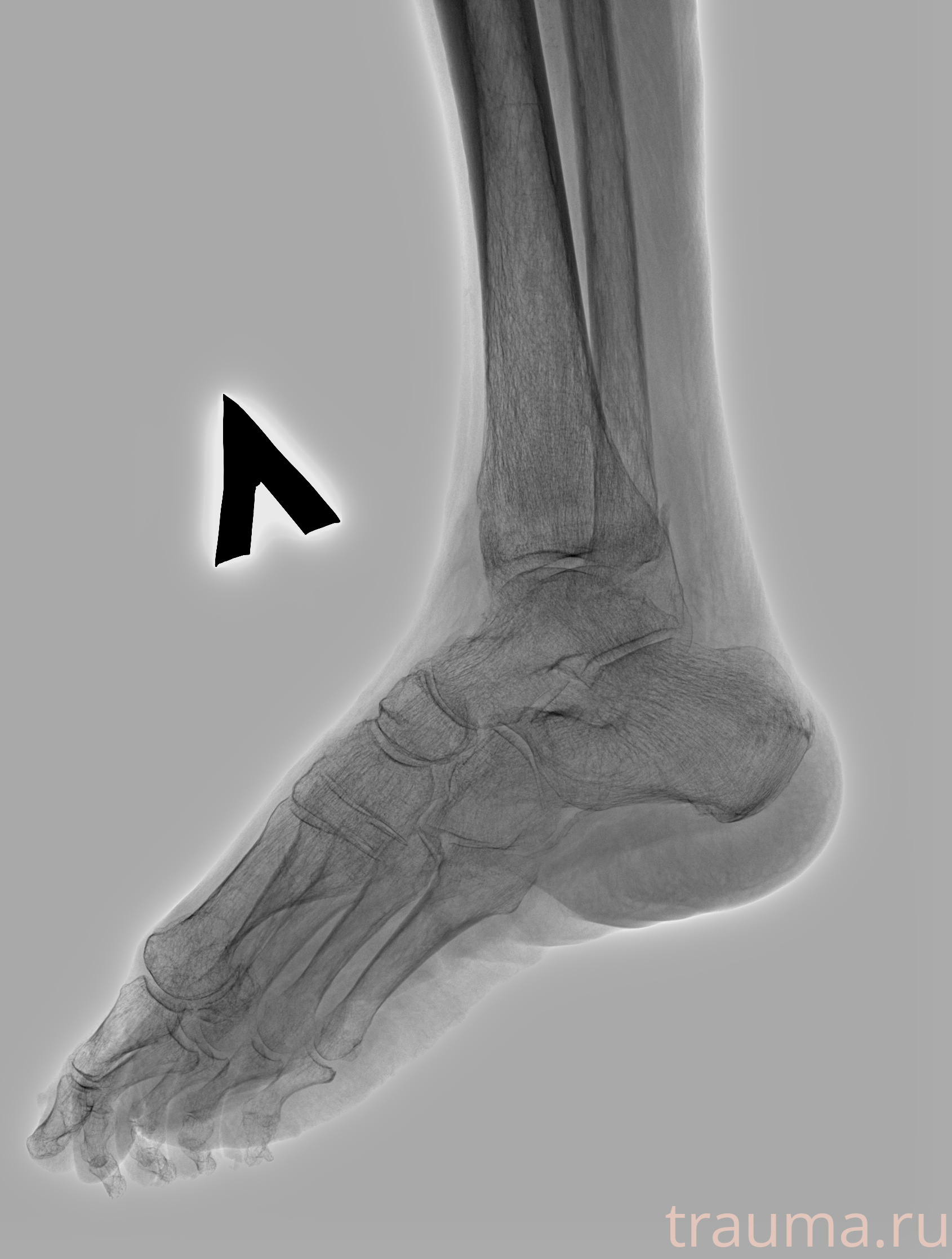 Рентген на дому: по вашему адресу приезжает врач-рентгенолог, травматолог-ортопед с мобильным рентгеновским аппаратом, проводит диагностику травмы или заболевания, делает необходимые рентгенограммы, дает рекомендации по дальнейшему лечению. Получить качественные снимки в домашних условиях возможно благодаря уникальной методике, разработанной МосРентген Центром для института  Склифосовского
