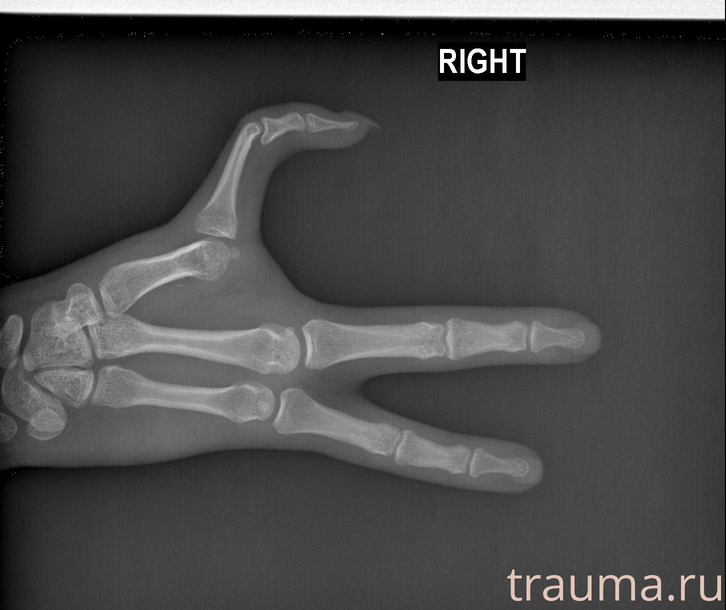 Рентген на дому: по вашему адресу приезжает врач-рентгенолог, травматолог-ортопед с мобильным рентгеновским аппаратом, проводит диагностику травмы или заболевания, делает необходимые рентгенограммы, дает рекомендации по дальнейшему лечению. Получить качественные снимки в домашних условиях возможно благодаря уникальной методике, разработанной МосРентген Центром для института  Склифосовского