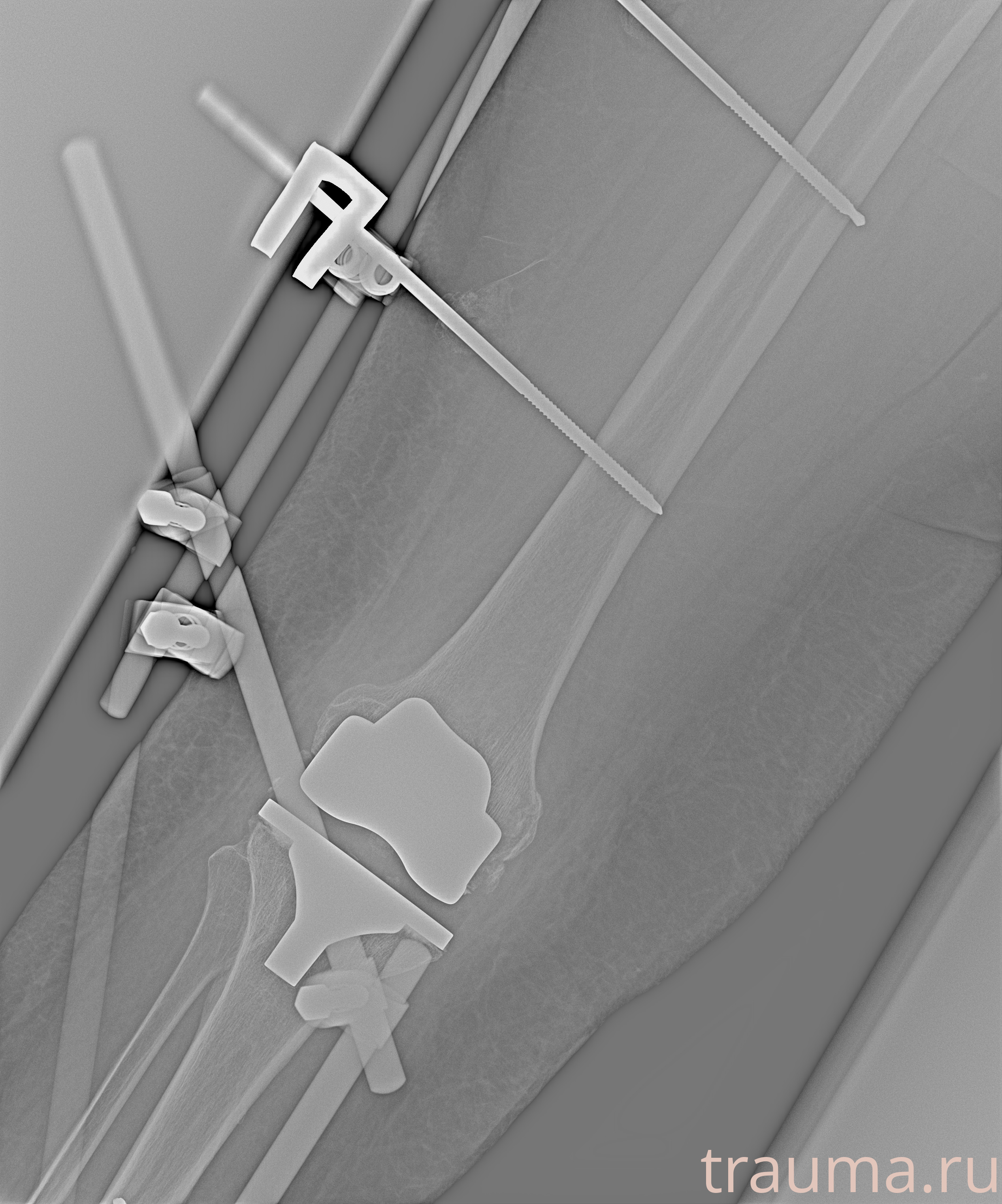 Рентген на дому: по вашему адресу приезжает врач-рентгенолог, травматолог-ортопед с мобильным рентгеновским аппаратом, проводит диагностику травмы или заболевания, делает необходимые рентгенограммы, дает рекомендации по дальнейшему лечению. Получить качественные снимки в домашних условиях возможно благодаря уникальной методике, разработанной МосРентген Центром для института  Склифосовского