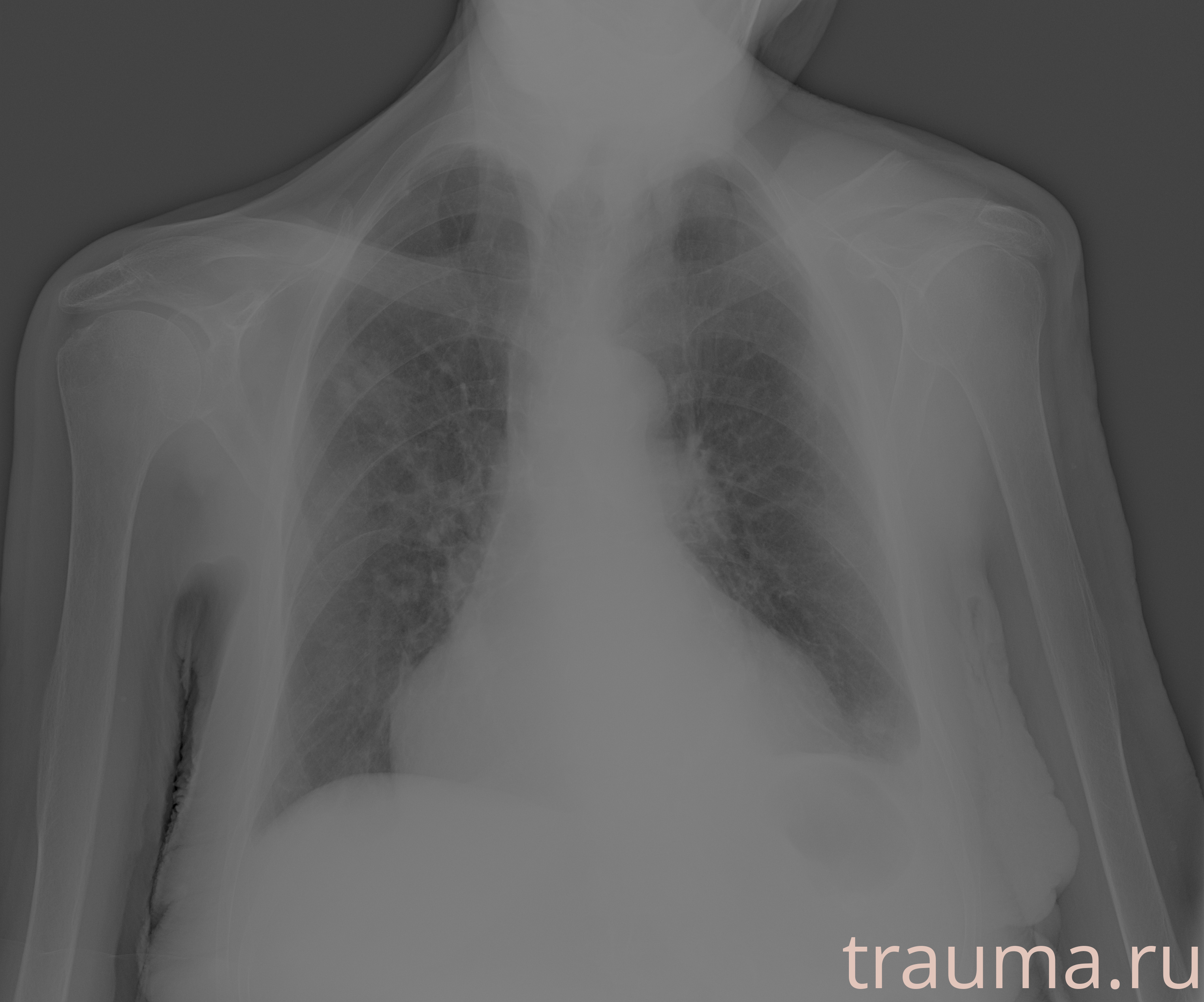 Рентген на дому: по вашему адресу приезжает врач-рентгенолог, травматолог-ортопед с мобильным рентгеновским аппаратом, проводит диагностику травмы или заболевания, делает необходимые рентгенограммы, дает рекомендации по дальнейшему лечению. Получить качественные снимки в домашних условиях возможно благодаря уникальной методике, разработанной МосРентген Центром для института  Склифосовского