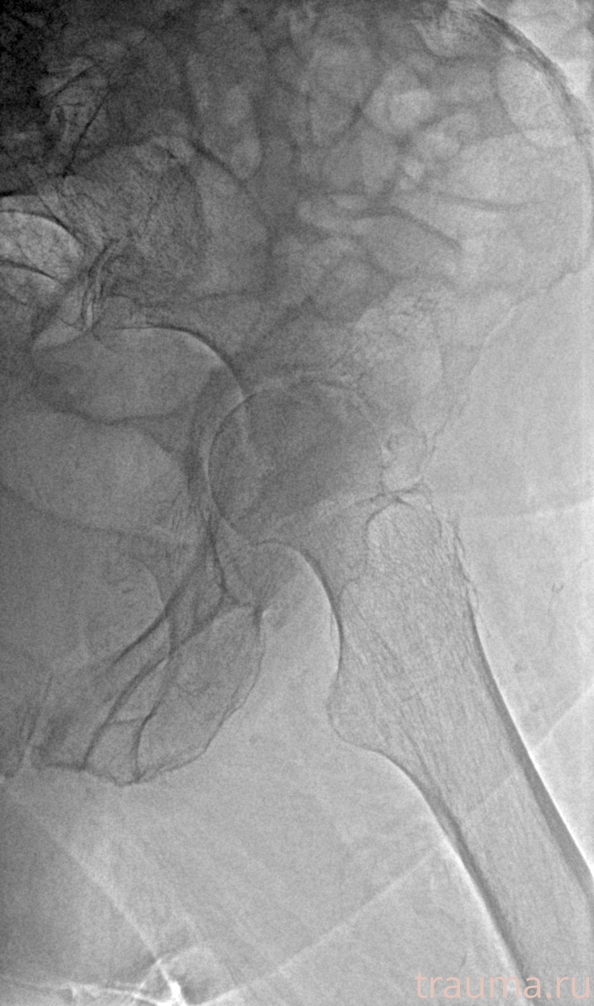 Рентген на дому: по вашему адресу приезжает врач-рентгенолог, травматолог-ортопед с мобильным рентгеновским аппаратом, проводит диагностику травмы или заболевания, делает необходимые рентгенограммы, дает рекомендации по дальнейшему лечению. Получить качественные снимки в домашних условиях возможно благодаря уникальной методике, разработанной МосРентген Центром для института  Склифосовского