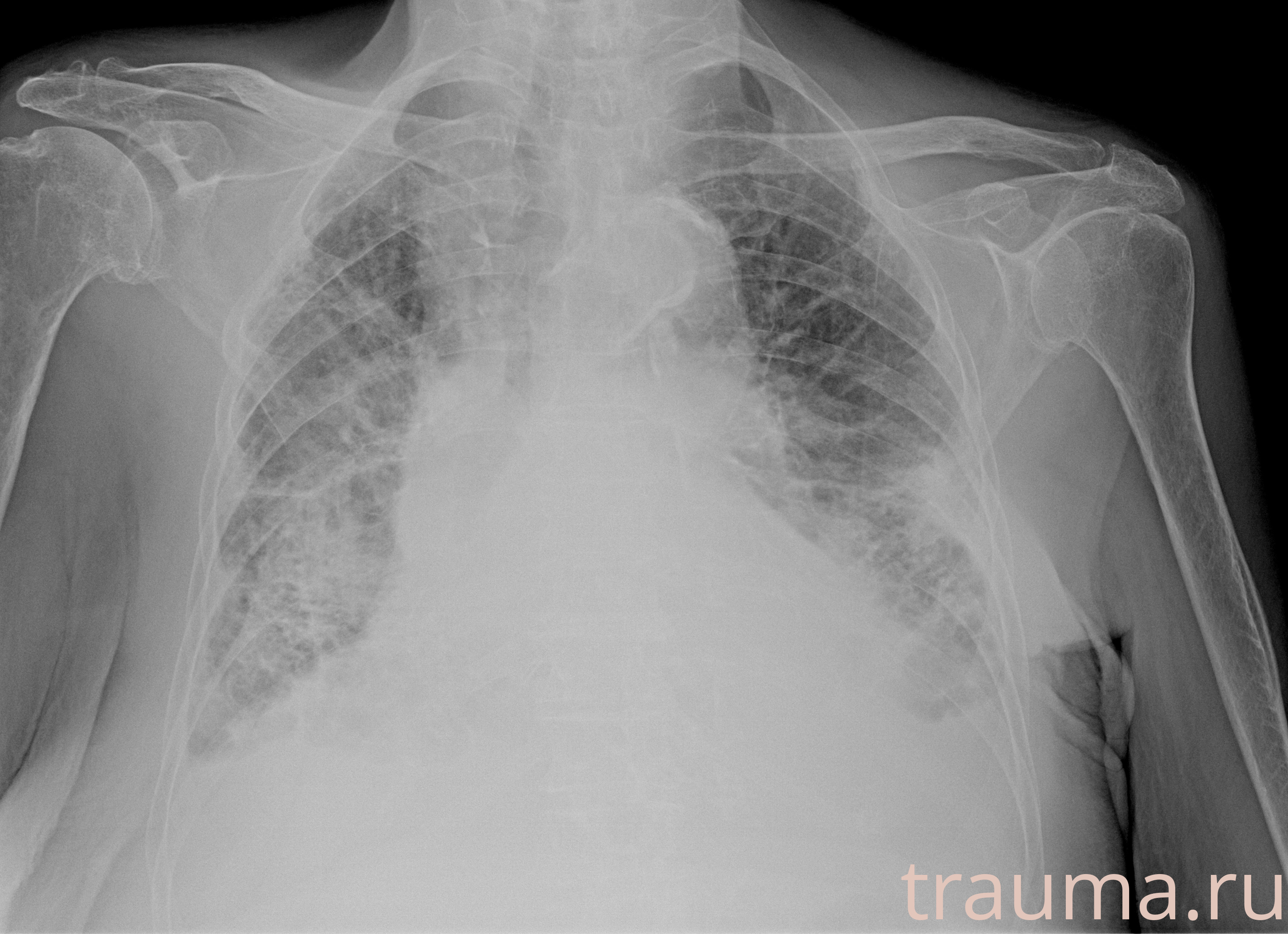 Рентген на дому: по вашему адресу приезжает врач-рентгенолог, травматолог-ортопед с мобильным рентгеновским аппаратом, проводит диагностику травмы или заболевания, делает необходимые рентгенограммы, дает рекомендации по дальнейшему лечению. Получить качественные снимки в домашних условиях возможно благодаря уникальной методике, разработанной МосРентген Центром для института  Склифосовского