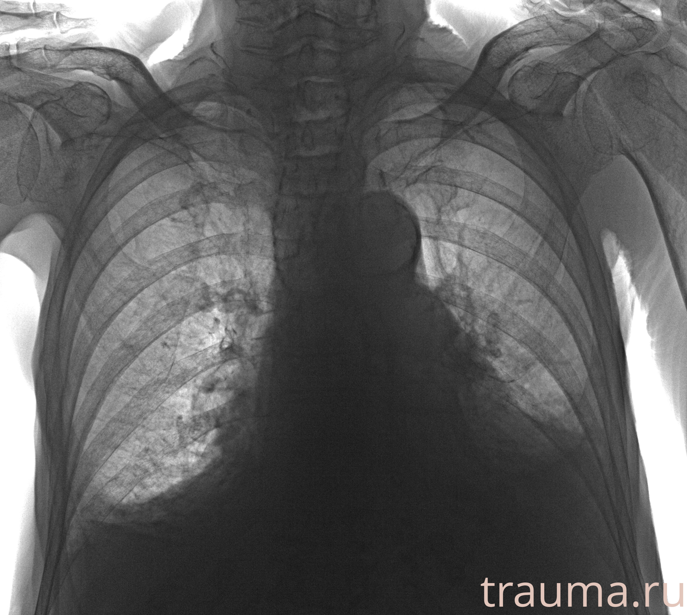 Рентген на дому: по вашему адресу приезжает врач-рентгенолог, травматолог-ортопед с мобильным рентгеновским аппаратом, проводит диагностику травмы или заболевания, делает необходимые рентгенограммы, дает рекомендации по дальнейшему лечению. Получить качественные снимки в домашних условиях возможно благодаря уникальной методике, разработанной МосРентген Центром для института  Склифосовского