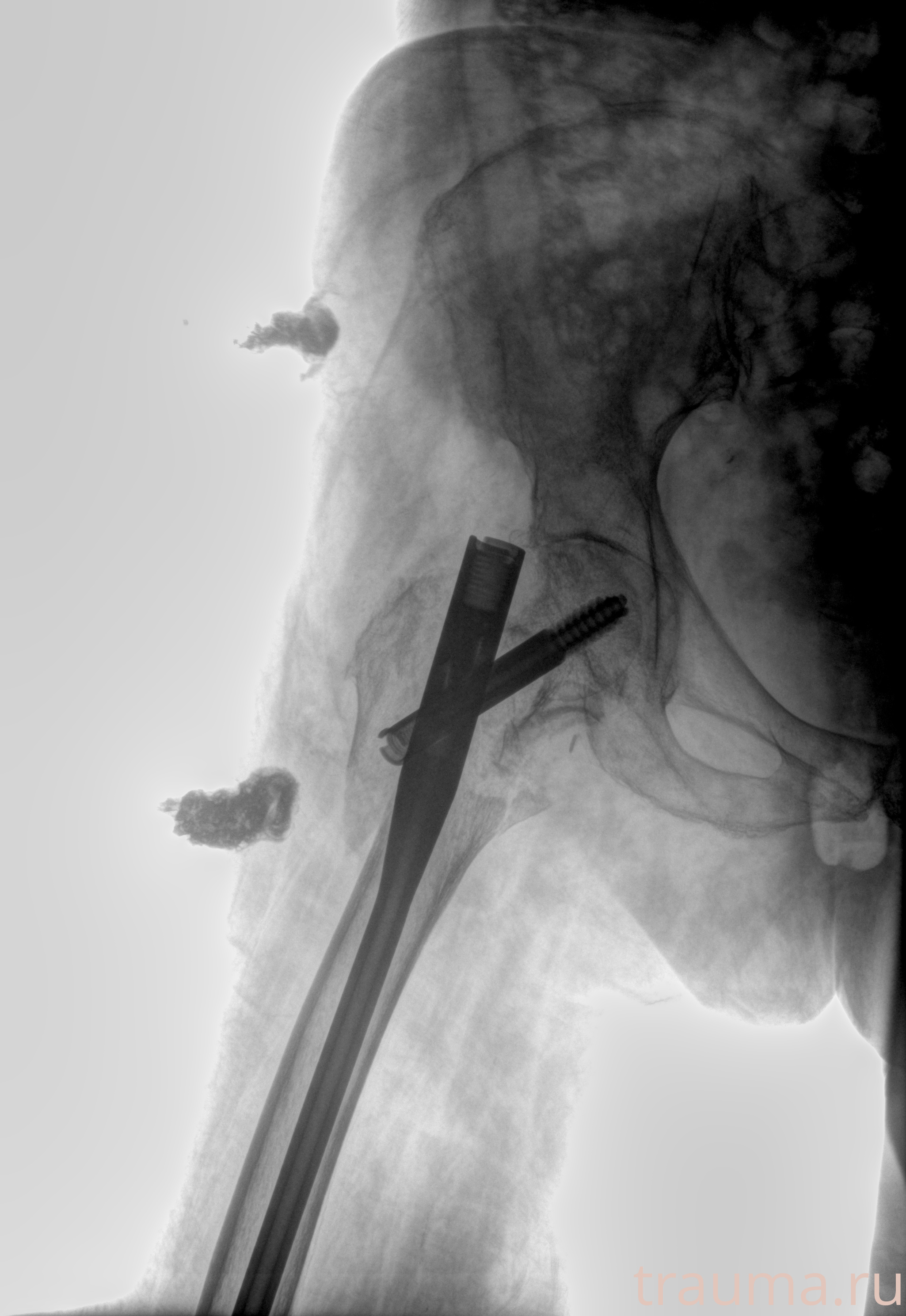 Рентген на дому: по вашему адресу приезжает врач-рентгенолог, травматолог-ортопед с мобильным рентгеновским аппаратом, проводит диагностику травмы или заболевания, делает необходимые рентгенограммы, дает рекомендации по дальнейшему лечению. Получить качественные снимки в домашних условиях возможно благодаря уникальной методике, разработанной МосРентген Центром для института  Склифосовского