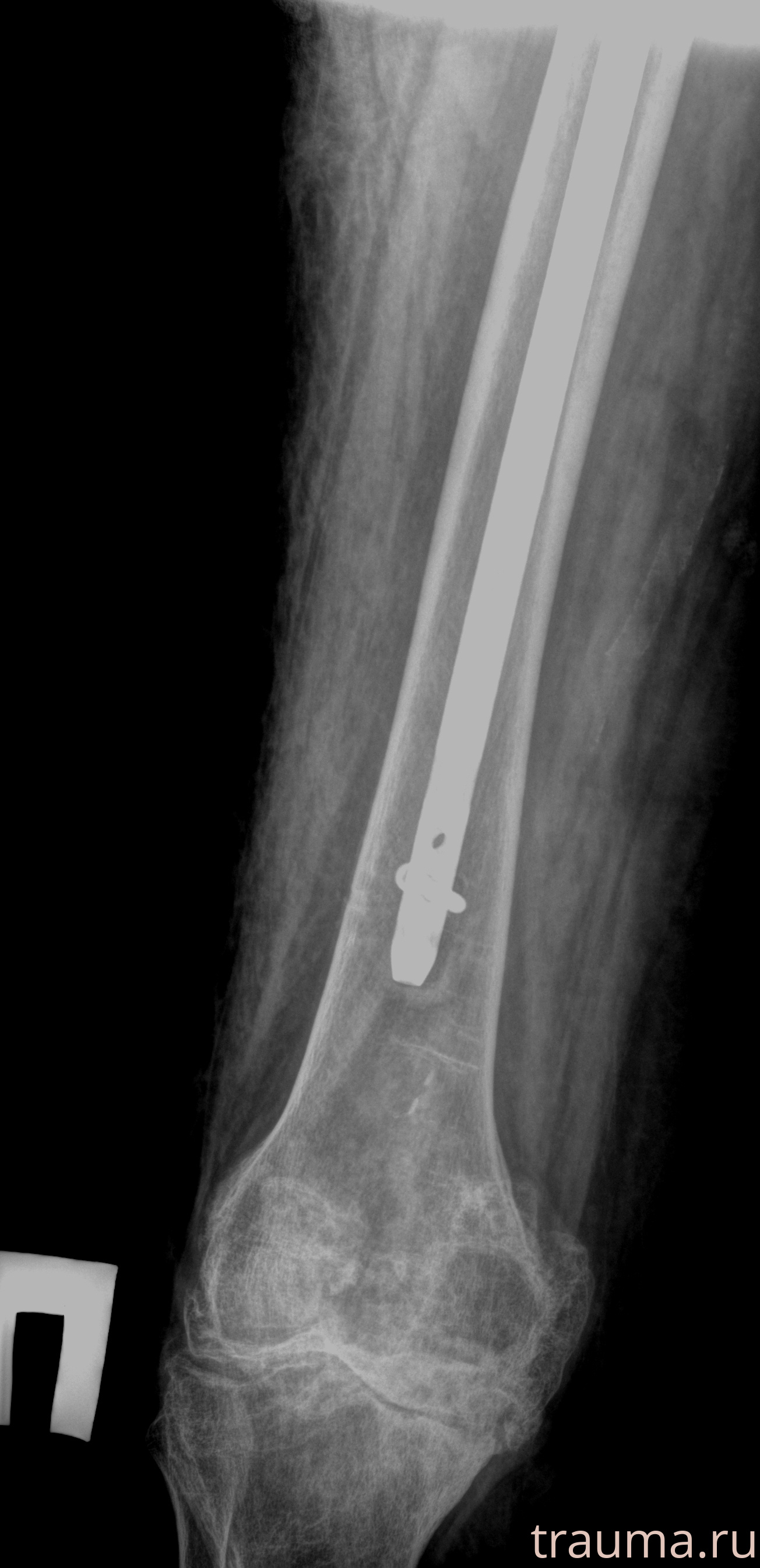 Рентген на дому: по вашему адресу приезжает врач-рентгенолог, травматолог-ортопед с мобильным рентгеновским аппаратом, проводит диагностику травмы или заболевания, делает необходимые рентгенограммы, дает рекомендации по дальнейшему лечению. Получить качественные снимки в домашних условиях возможно благодаря уникальной методике, разработанной МосРентген Центром для института  Склифосовского