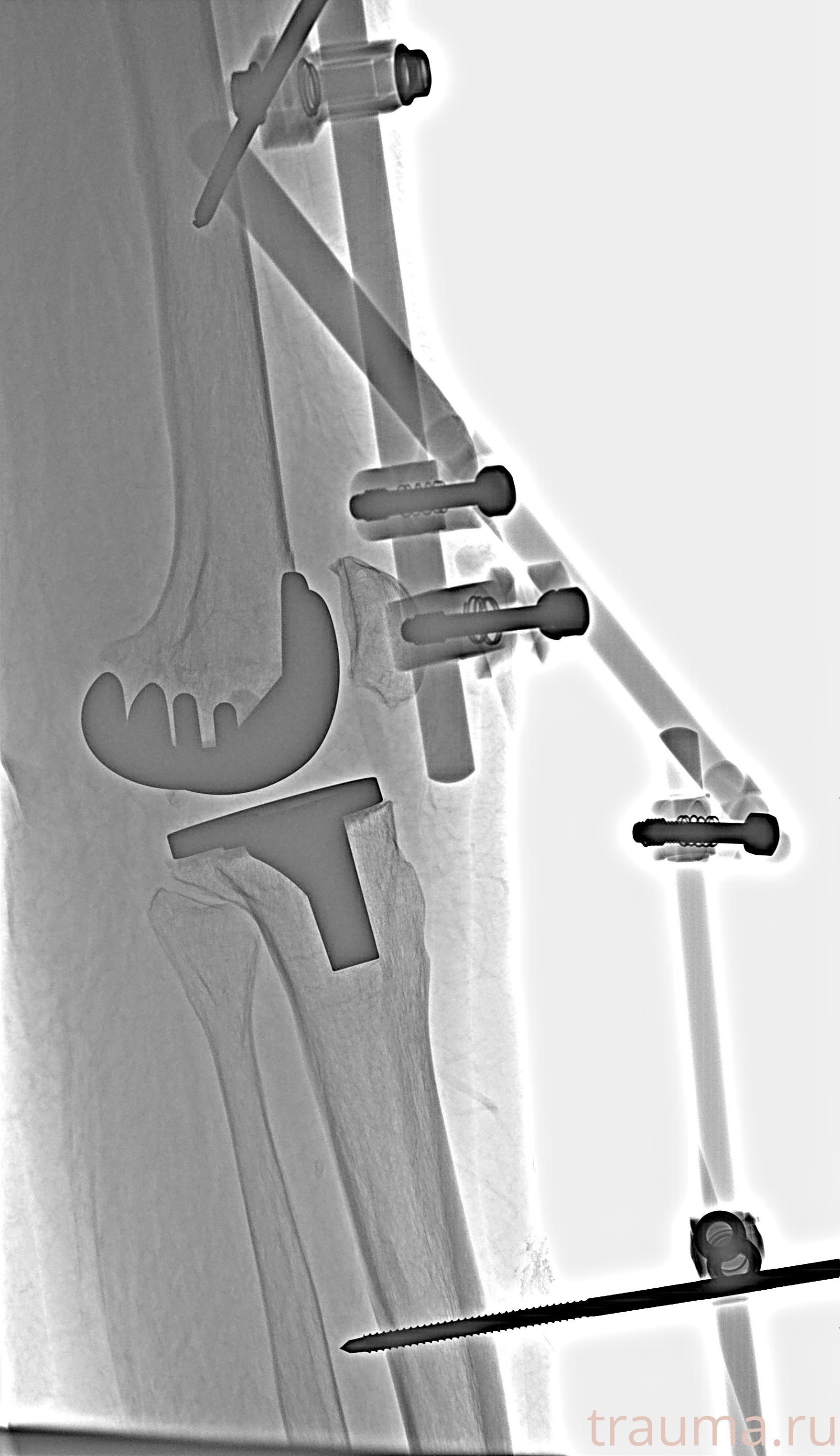 Рентген на дому: по вашему адресу приезжает врач-рентгенолог, травматолог-ортопед с мобильным рентгеновским аппаратом, проводит диагностику травмы или заболевания, делает необходимые рентгенограммы, дает рекомендации по дальнейшему лечению. Получить качественные снимки в домашних условиях возможно благодаря уникальной методике, разработанной МосРентген Центром для института  Склифосовского