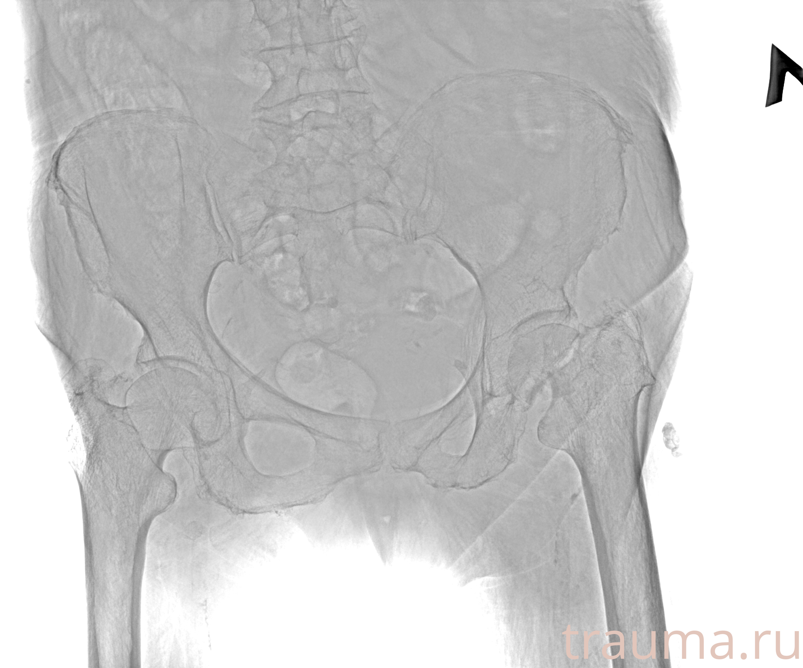 Рентген на дому: по вашему адресу приезжает врач-рентгенолог, травматолог-ортопед с мобильным рентгеновским аппаратом, проводит диагностику травмы или заболевания, делает необходимые рентгенограммы, дает рекомендации по дальнейшему лечению. Получить качественные снимки в домашних условиях возможно благодаря уникальной методике, разработанной МосРентген Центром для института  Склифосовского